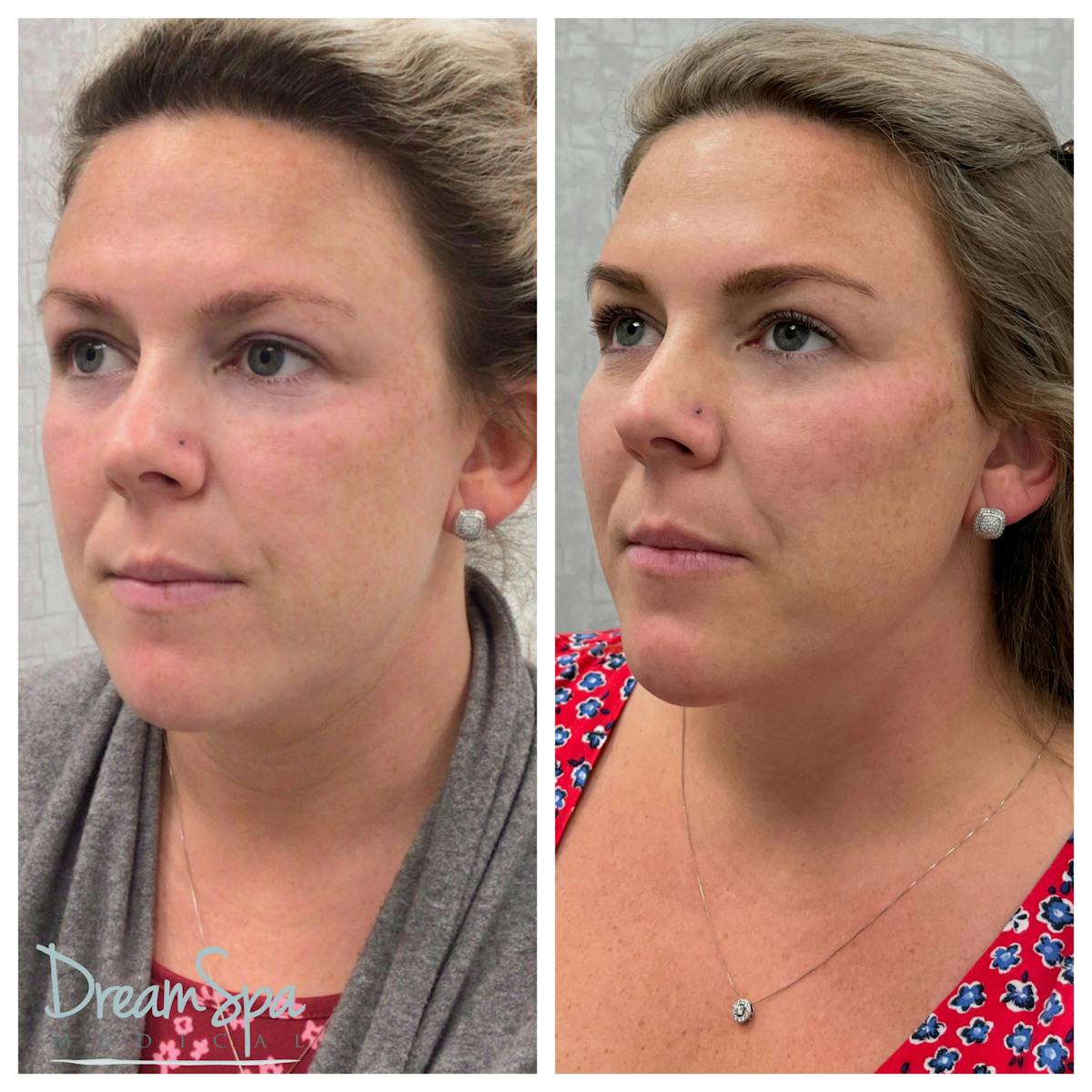 Confident Cheeks Before & After Gallery - Patient 121819240 - Image 1