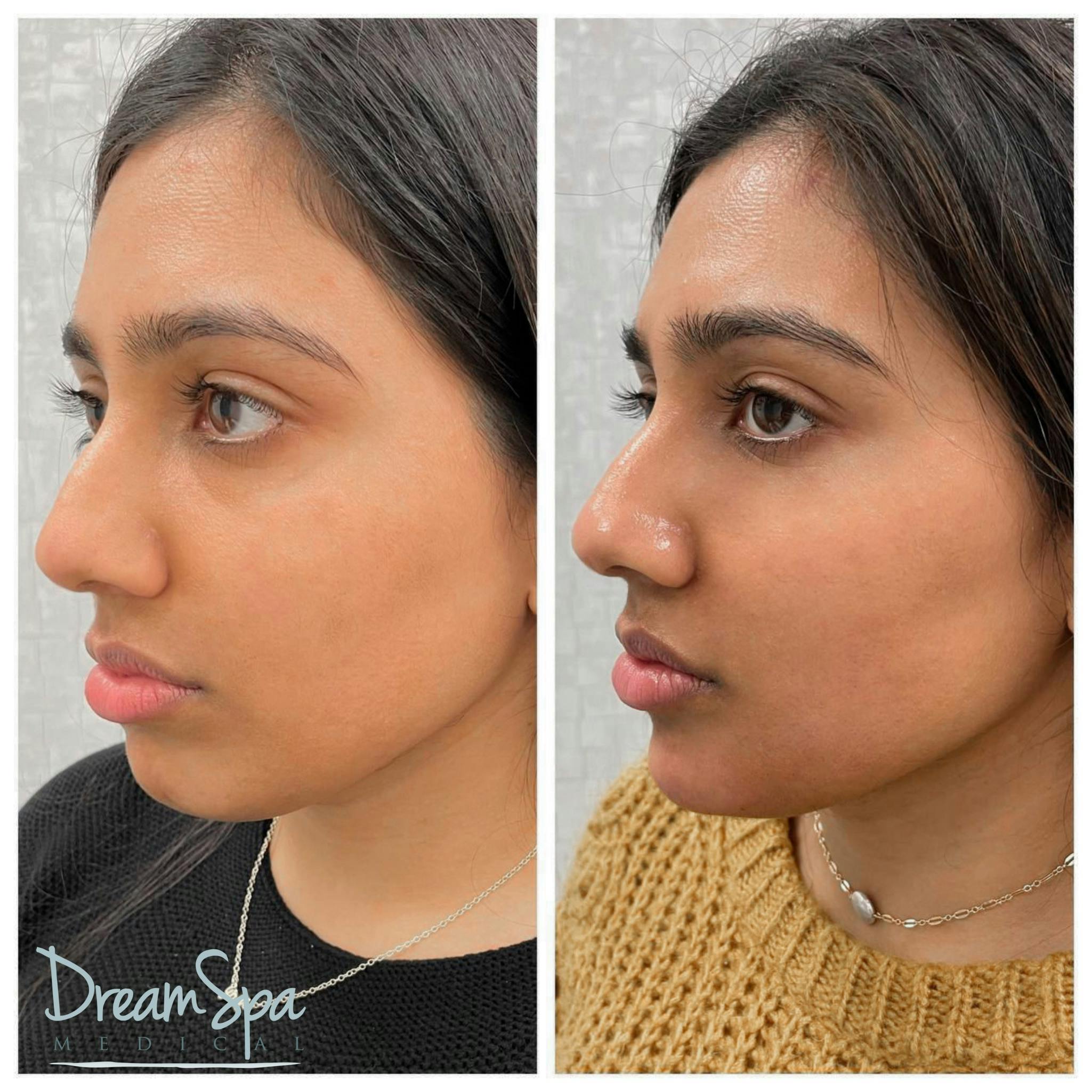Confident Cheeks Before & After Gallery - Patient 121819241 - Image 1