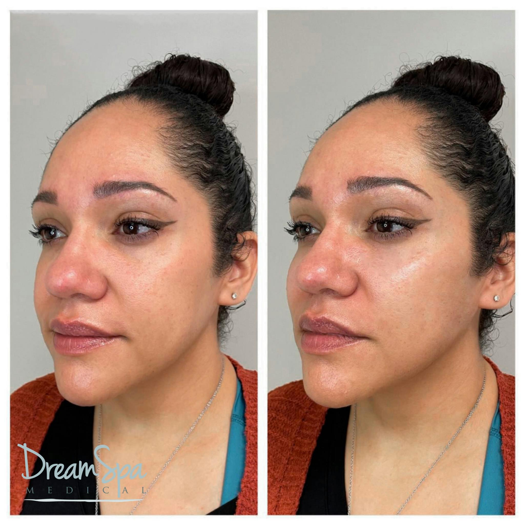 Cheek Filler Before & After Gallery - Patient 72510327 - Image 1