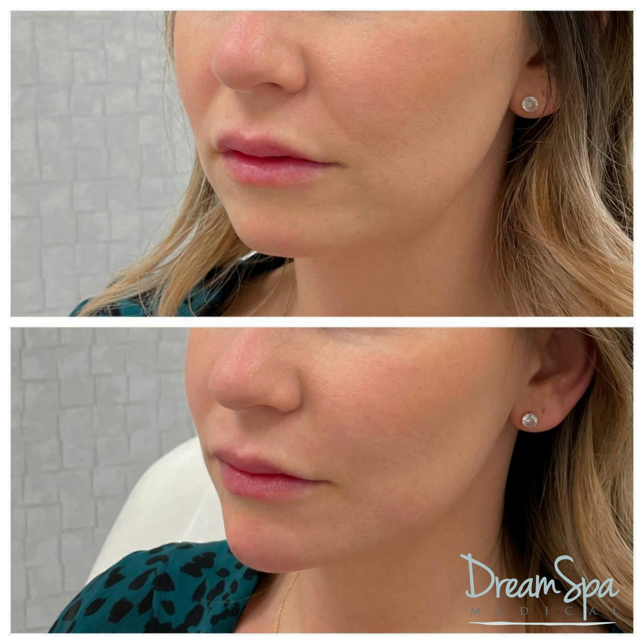 Chin Filler Before & After Gallery - Patient 72510335 - Image 1