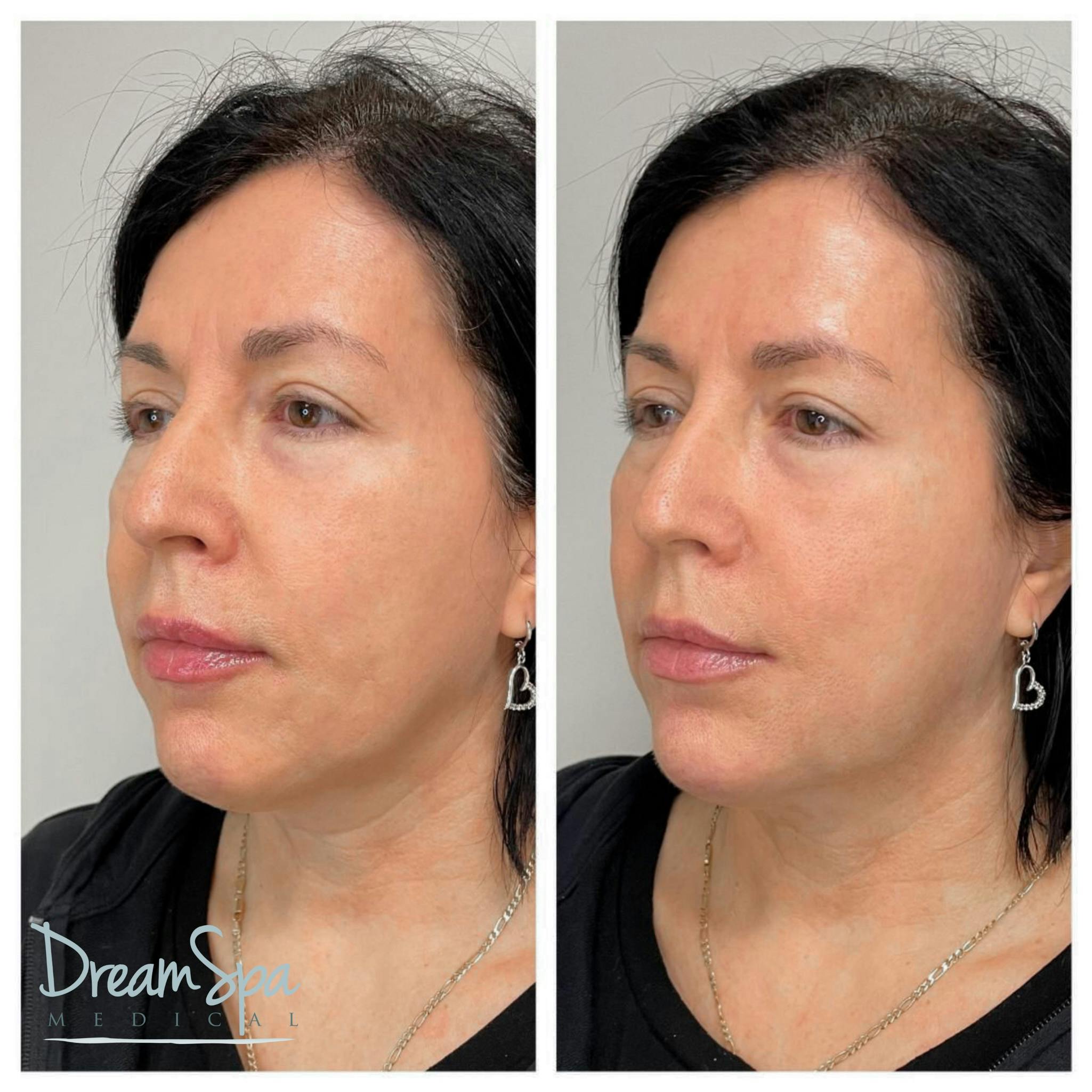 Chin Filler Before & After Gallery - Patient 72510336 - Image 1