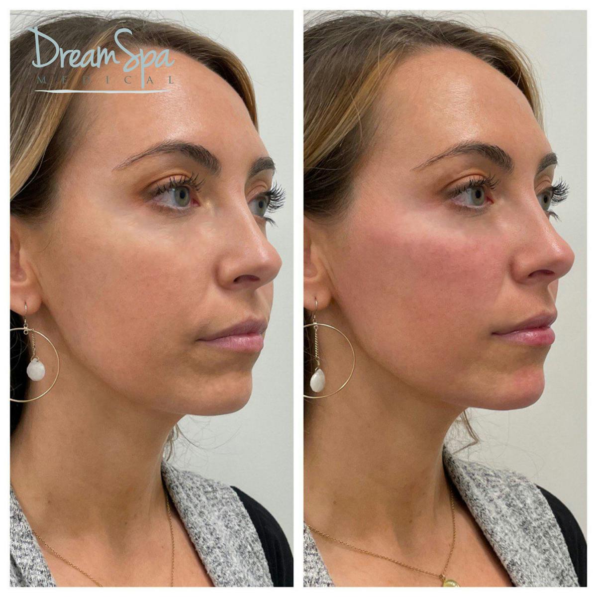 Chin Filler Before & After Gallery - Patient 72510337 - Image 1
