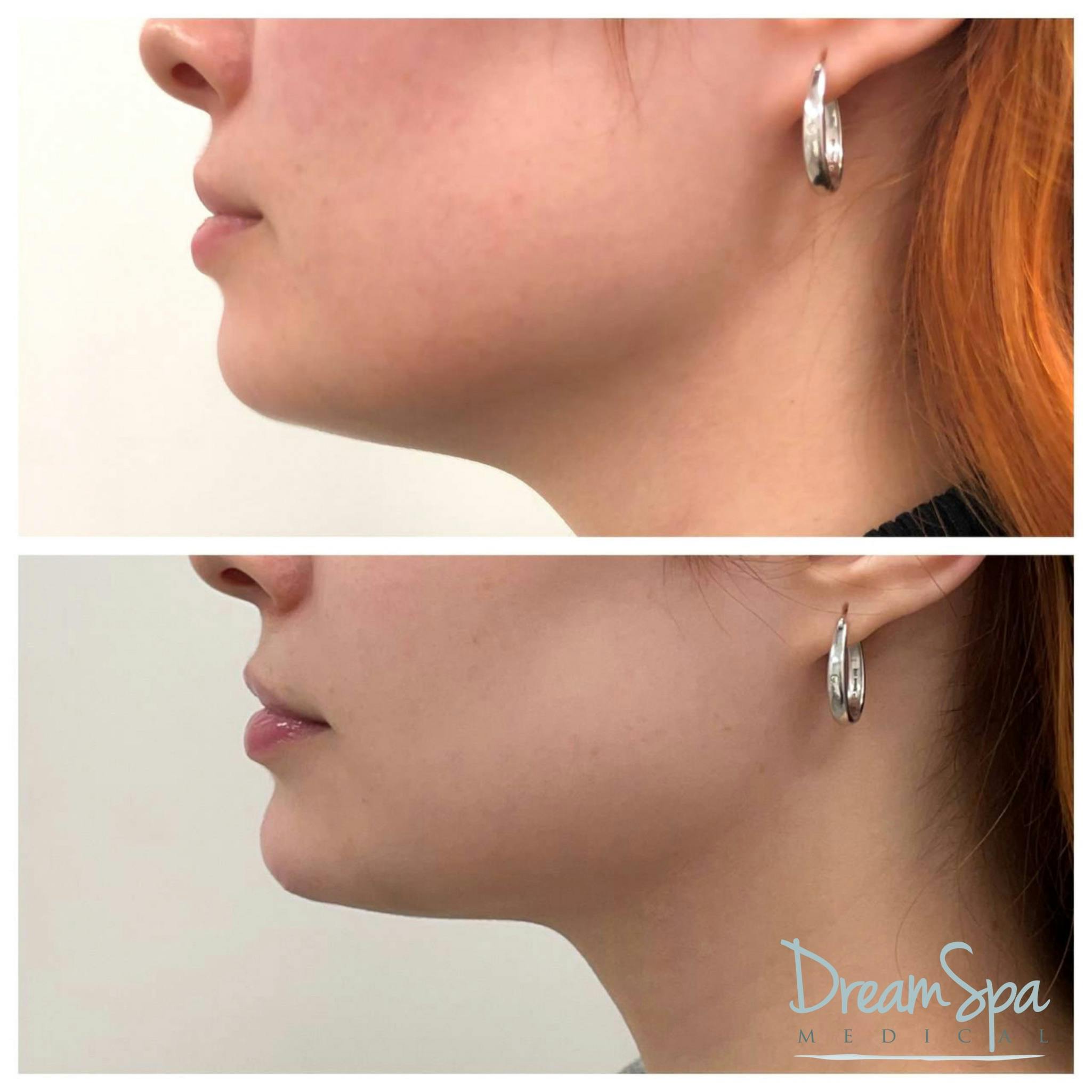 Chin Filler Before & After Gallery - Patient 72510338 - Image 1