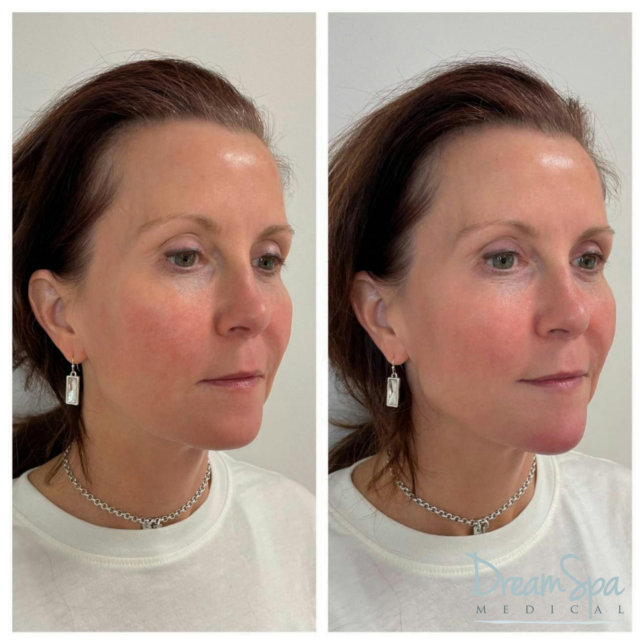 Chin Filler Before & After Gallery - Patient 72510339 - Image 1