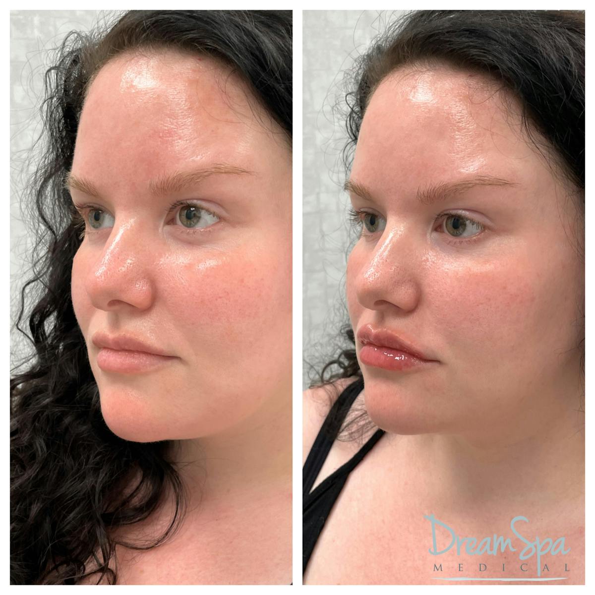 Dream Contour™ Before & After Gallery - Patient 72510349 - Image 1