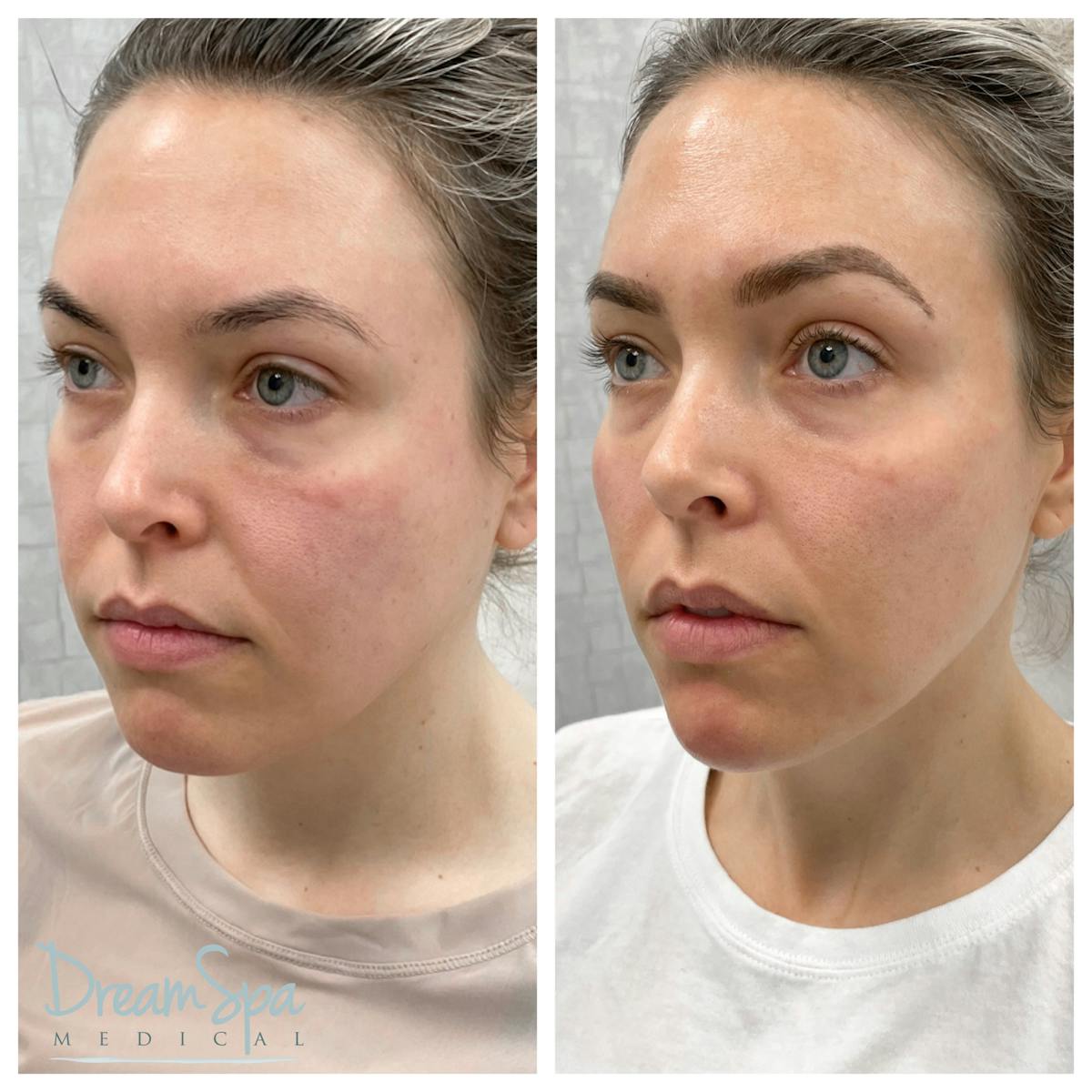 Dream Contour™ Before & After Gallery - Patient 72510350 - Image 1