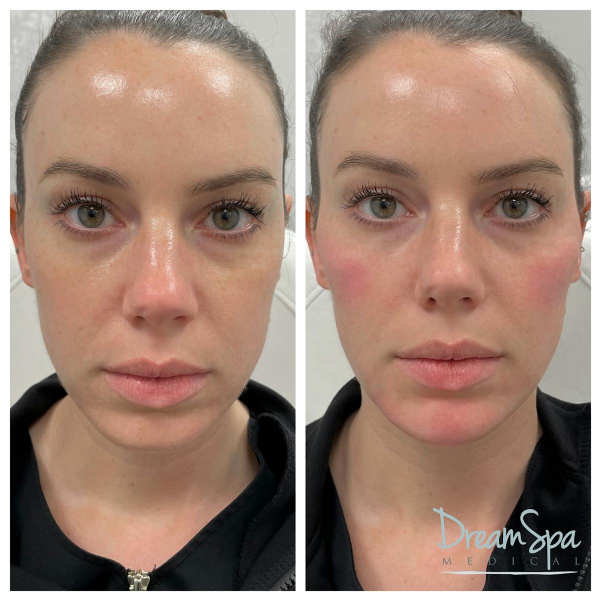 Dream Contour™ Before & After Gallery - Patient 72510351 - Image 1