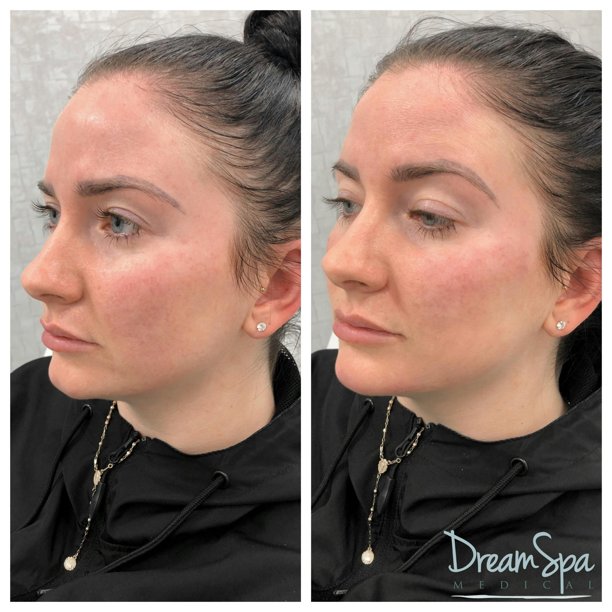 Dream Contour™ Before & After Gallery - Patient 72510352 - Image 1