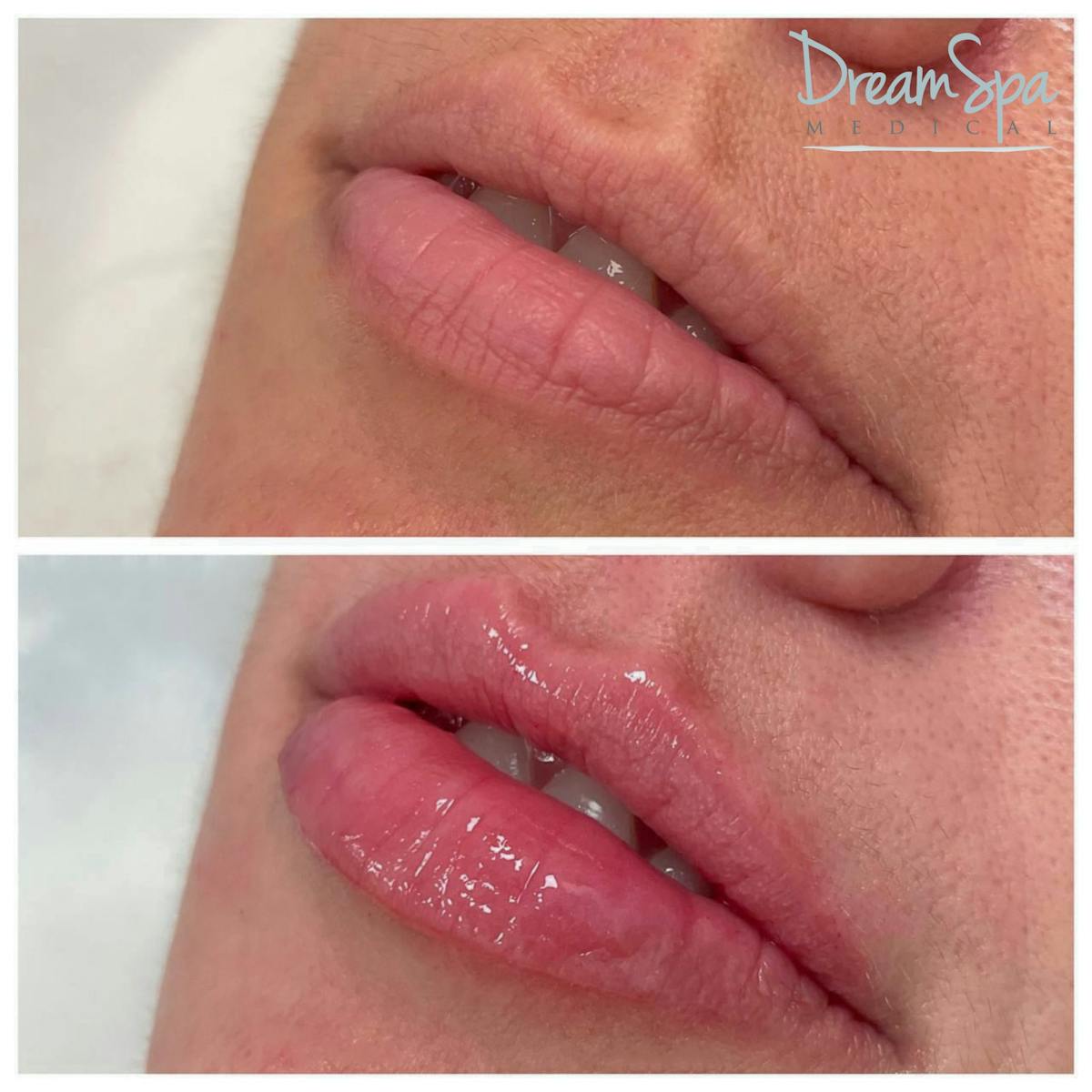 Lip Filler Before & After Gallery - Patient 72510356 - Image 1