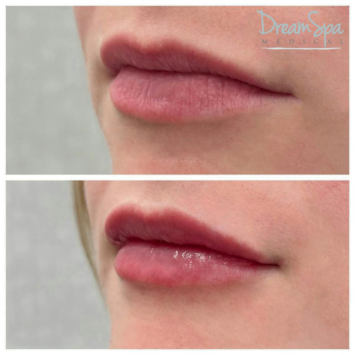 Lip Filler Before & After Gallery - Patient 72510357 - Image 1