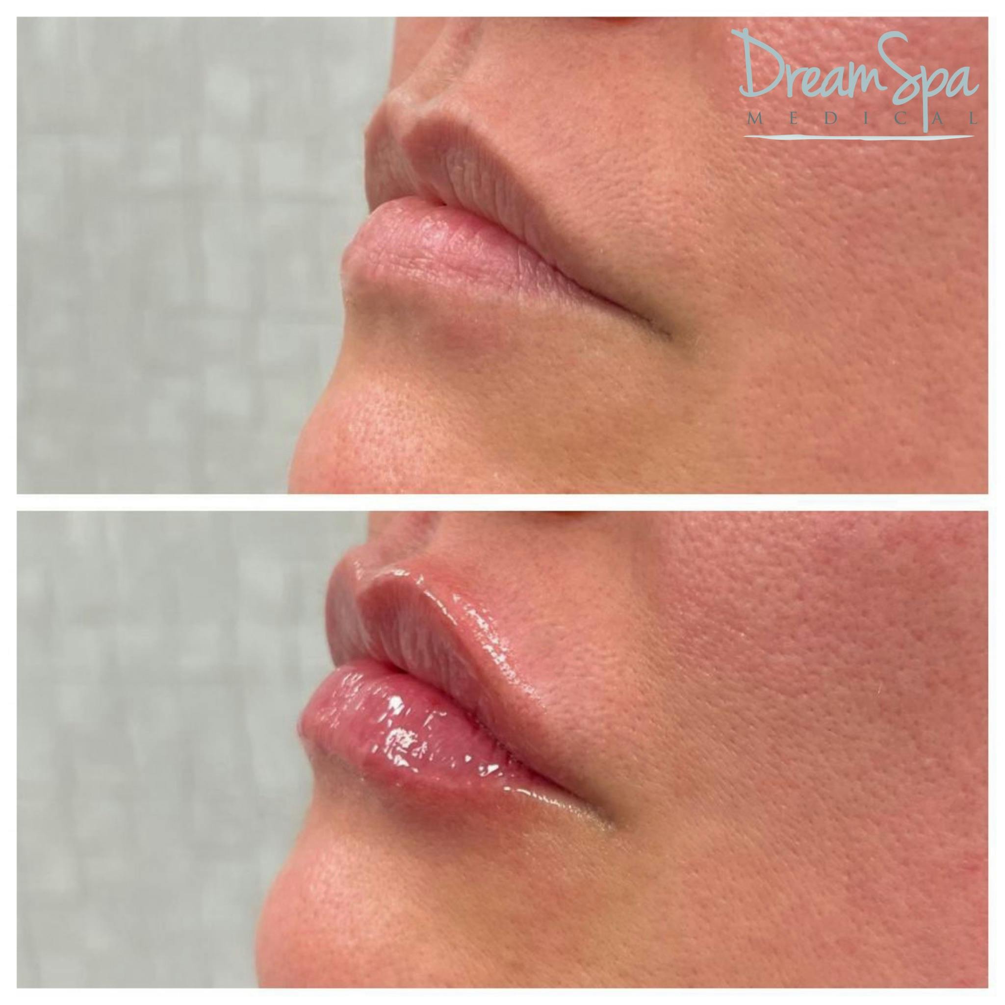 Lip Filler Before & After Gallery - Patient 72510358 - Image 1