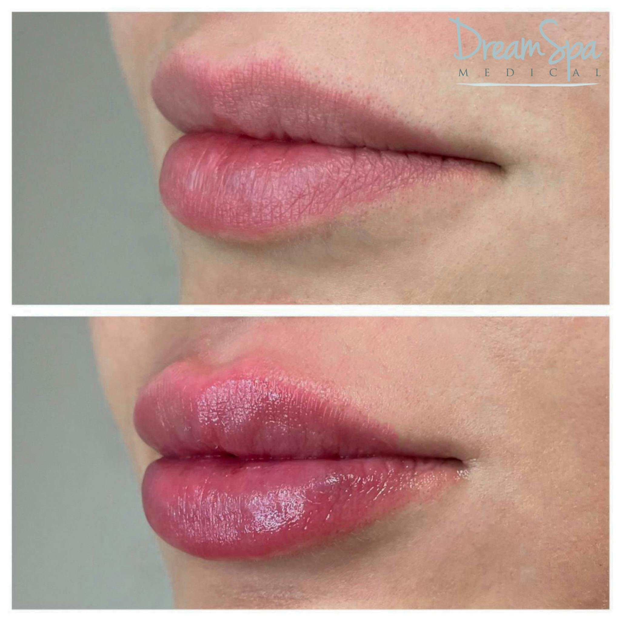 Lip Filler Before & After Gallery - Patient 72510359 - Image 1