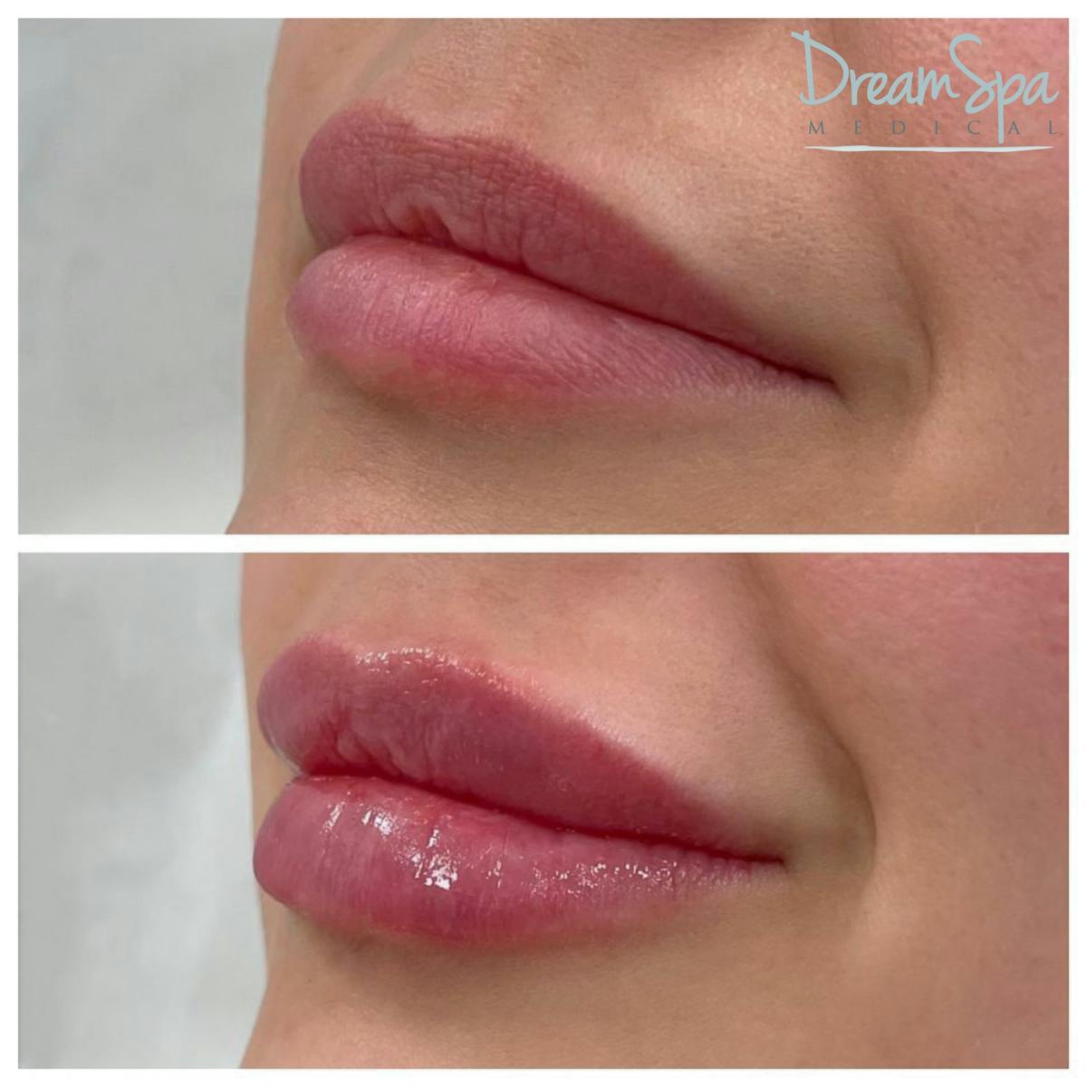 Lip Filler Before & After Gallery - Patient 72510360 - Image 1