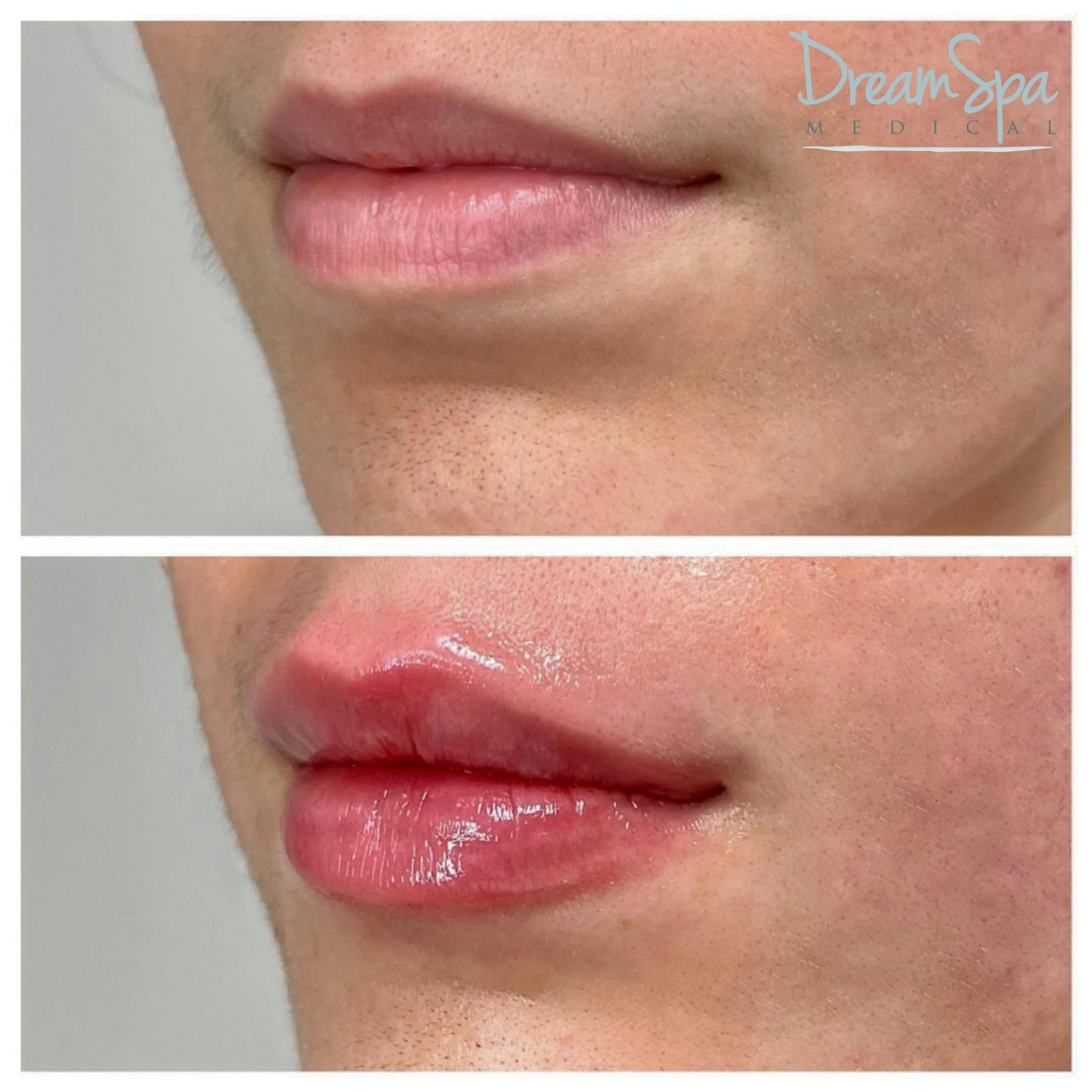 Lip Filler Before & After Gallery - Patient 72510361 - Image 1