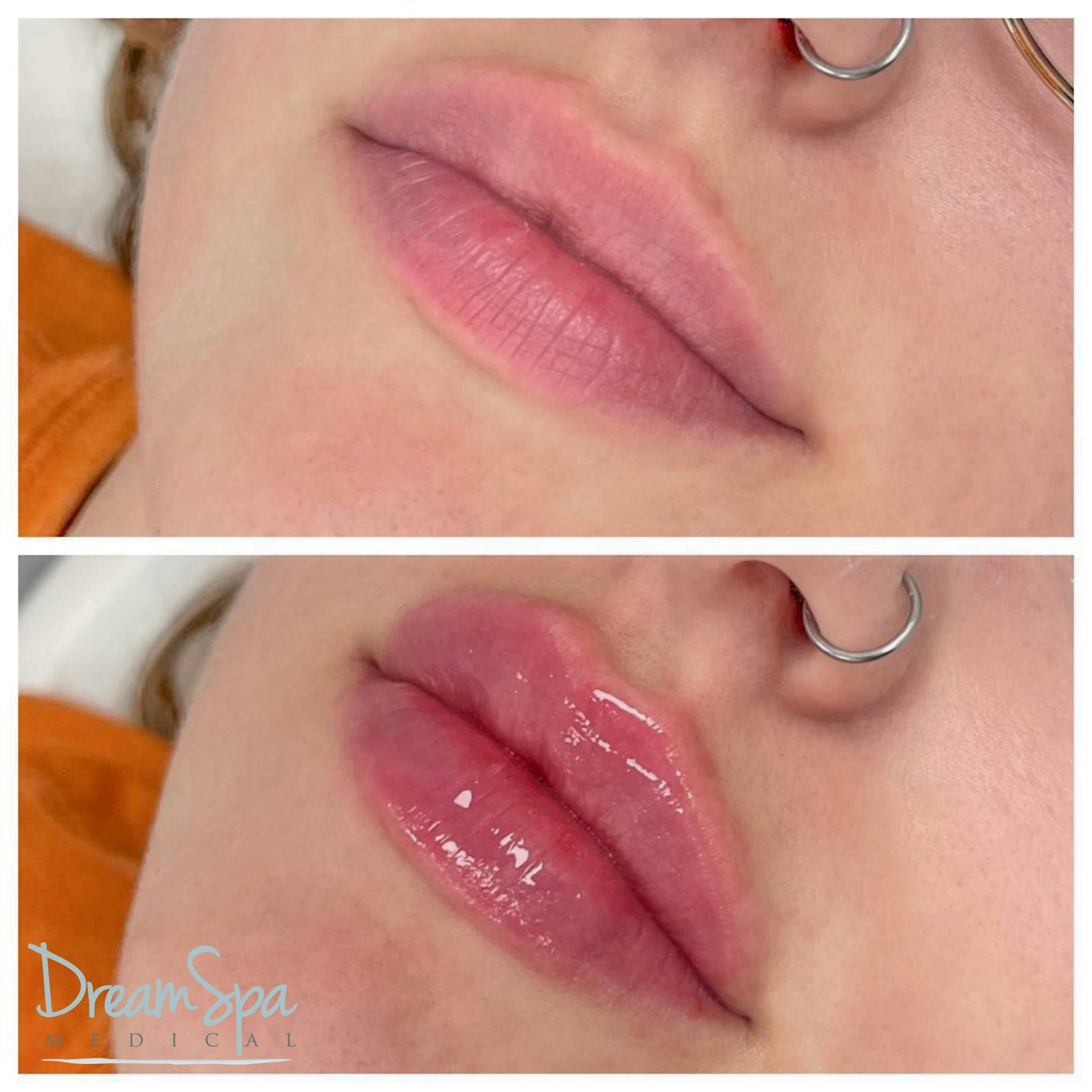Lip Filler Before & After Gallery - Patient 72510362 - Image 1