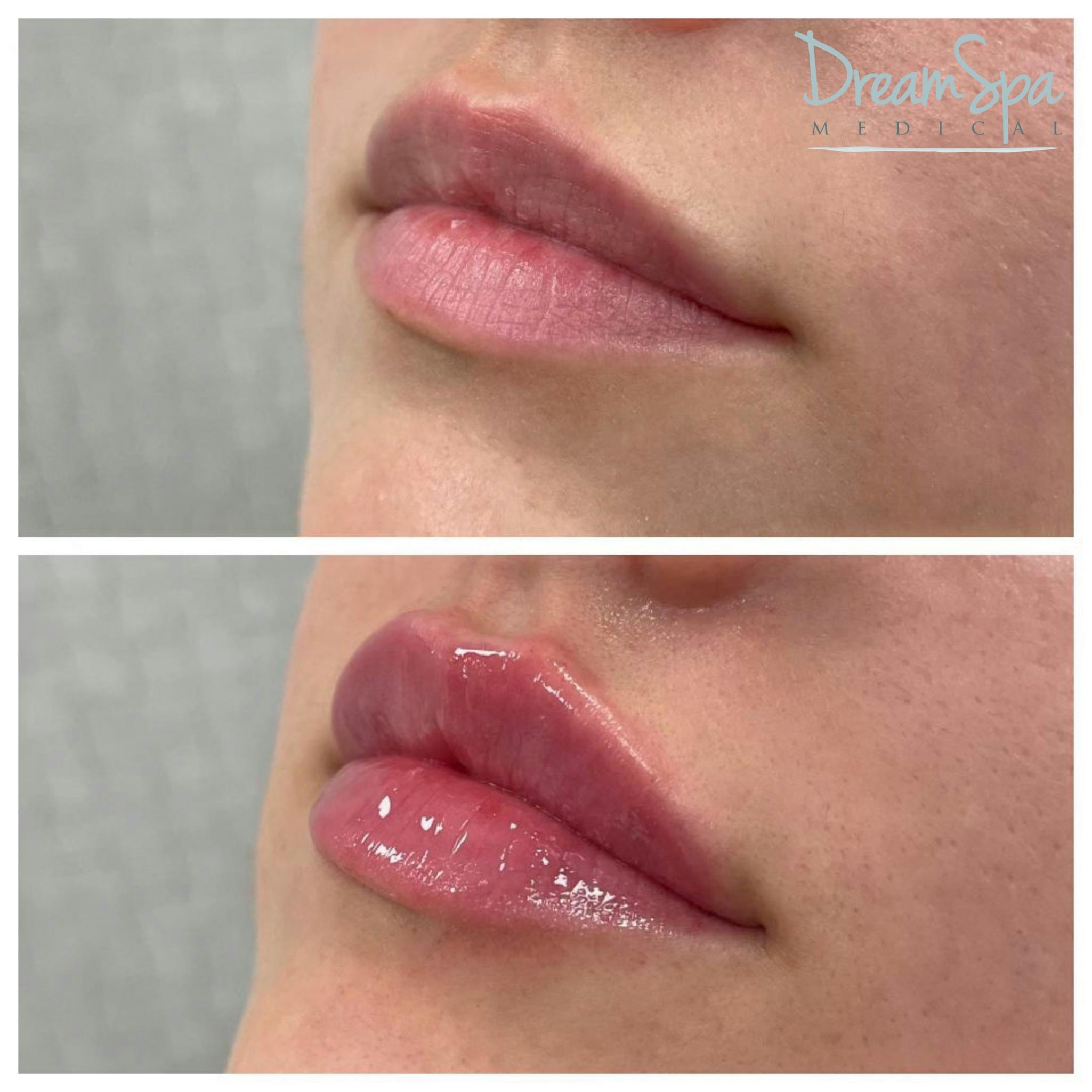 Lip Filler Before & After Gallery - Patient 72510363 - Image 1