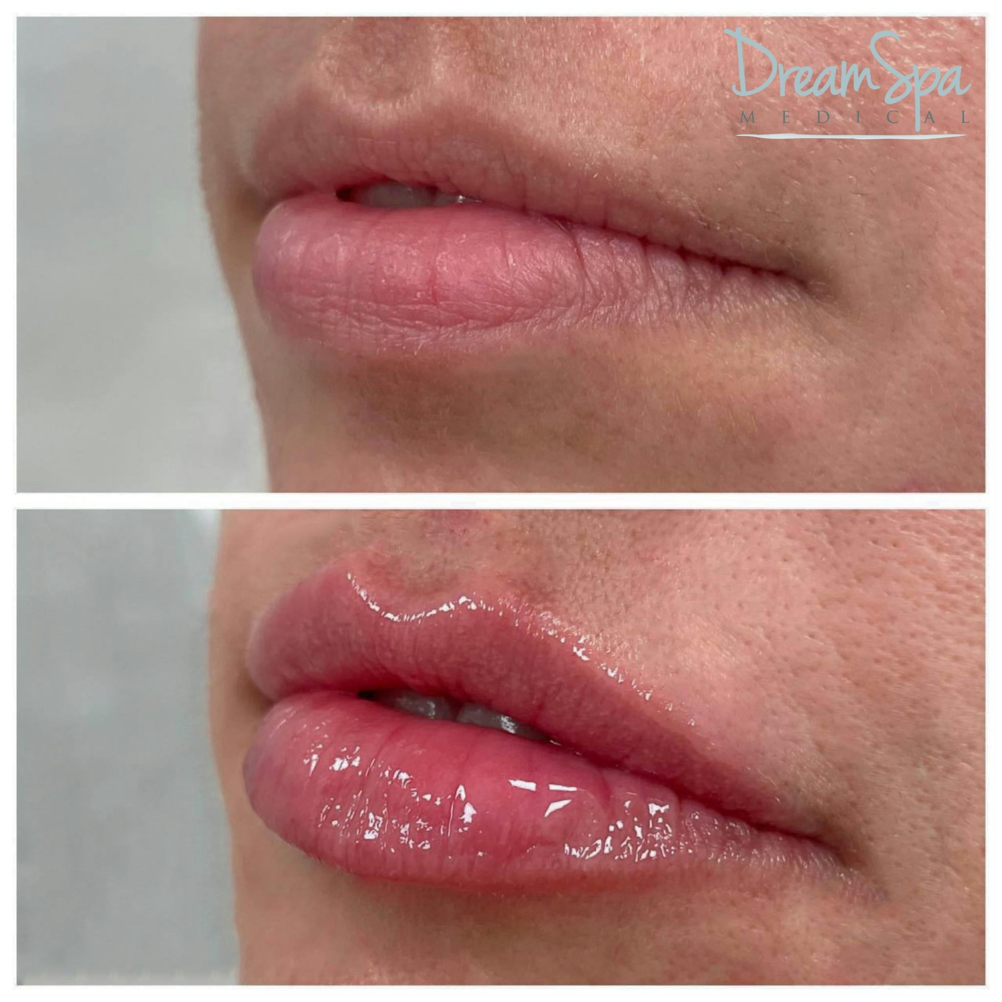 Lip Filler Before & After Gallery - Patient 72510364 - Image 1