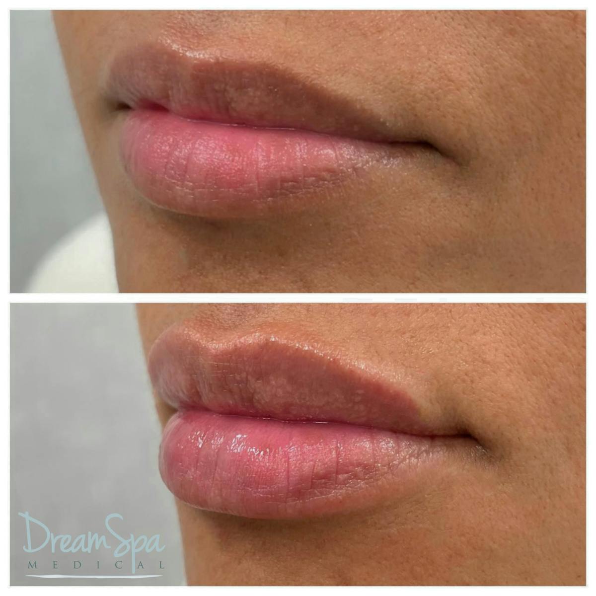 Lip Filler Before & After Gallery - Patient 72510365 - Image 1