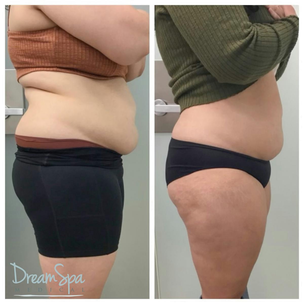 Body Contouring Before & After Gallery - Patient 109504933 - Image 1