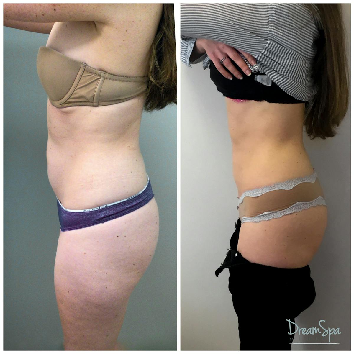 Body Contouring Before & After Gallery - Patient 109504934 - Image 1