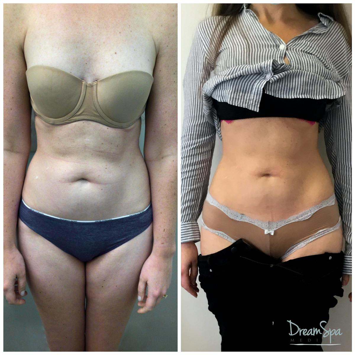 Body Contouring Before & After Gallery - Patient 109504935 - Image 1