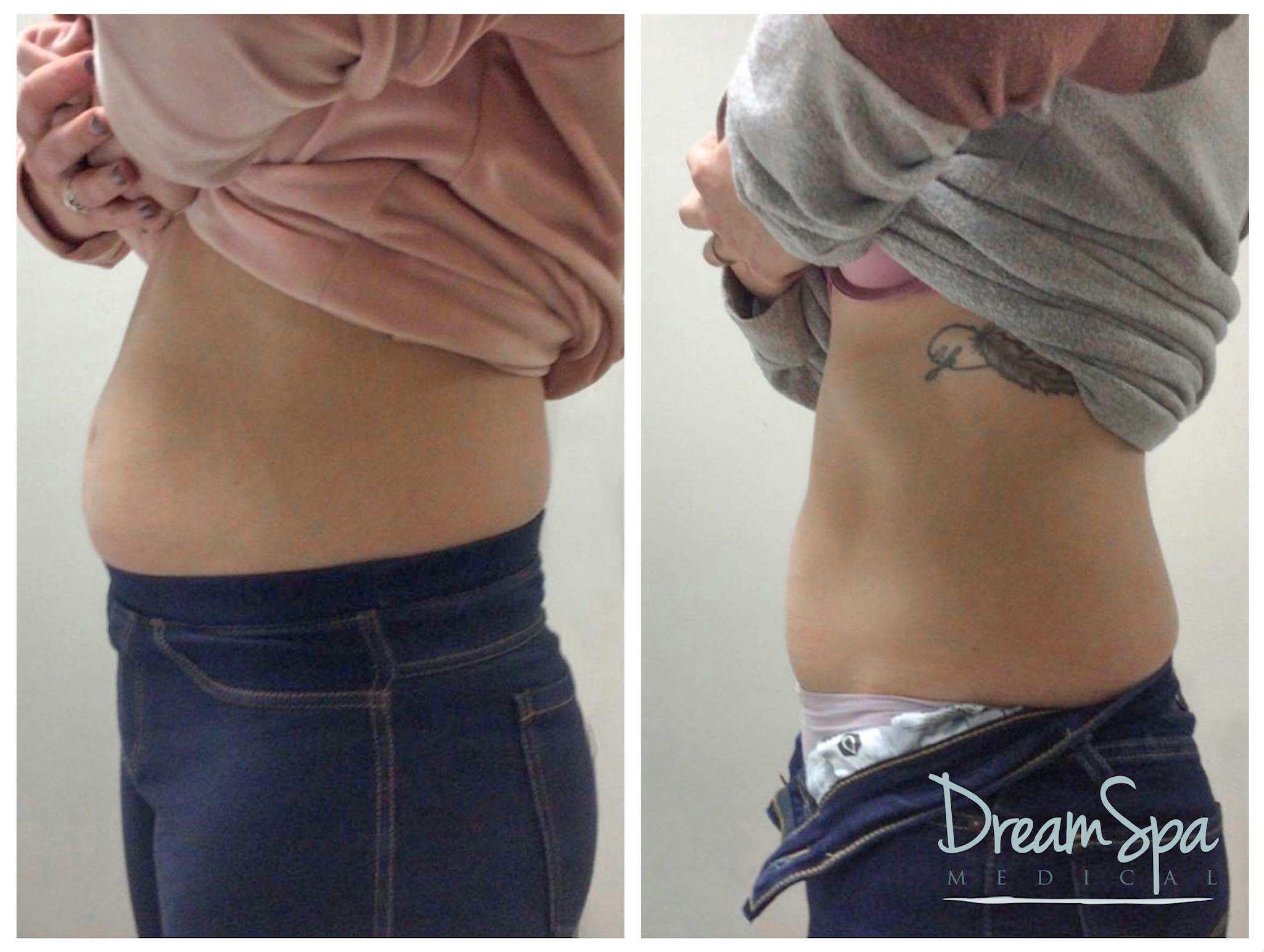 Body Contouring Before & After Photos Page 2 Dream Spa Medical