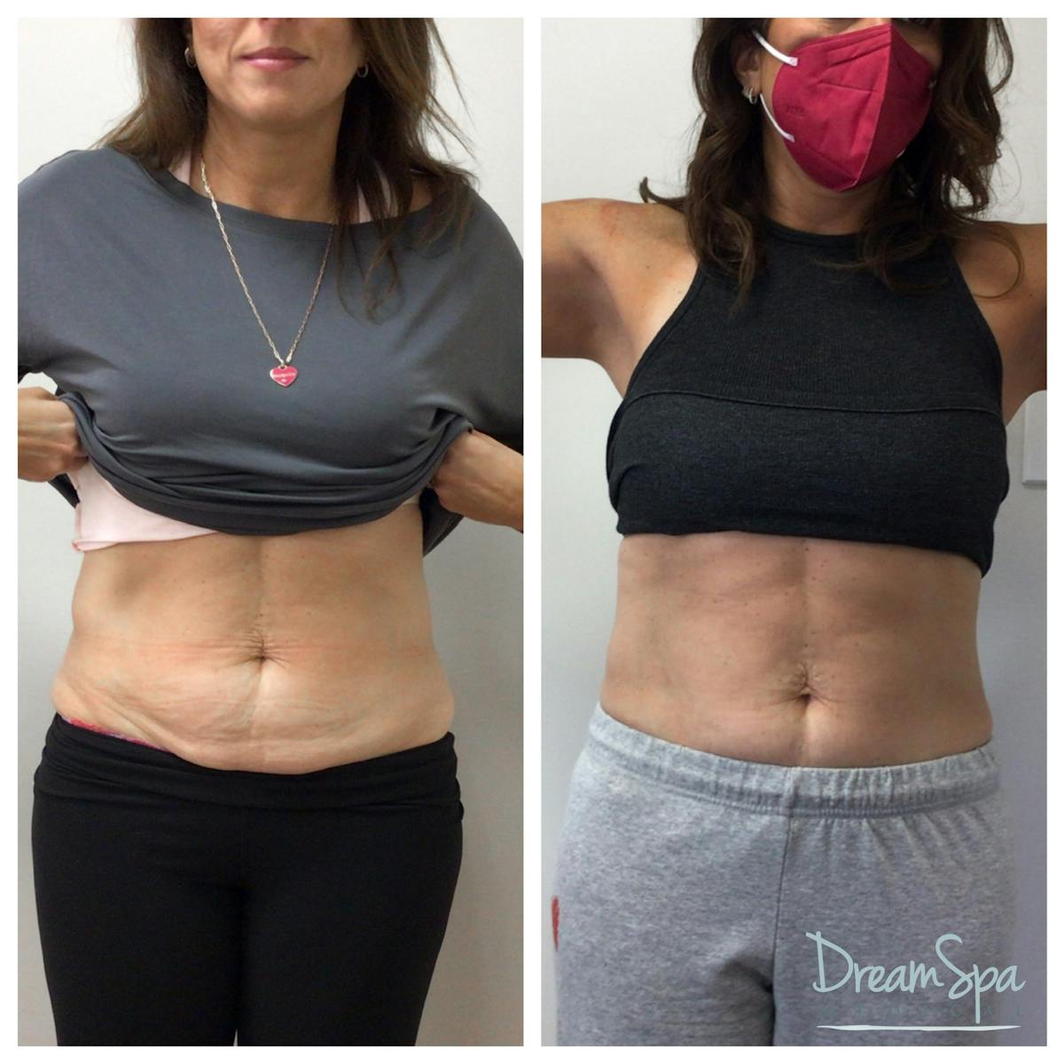 Body Contouring Before & After Gallery - Patient 109504937 - Image 1