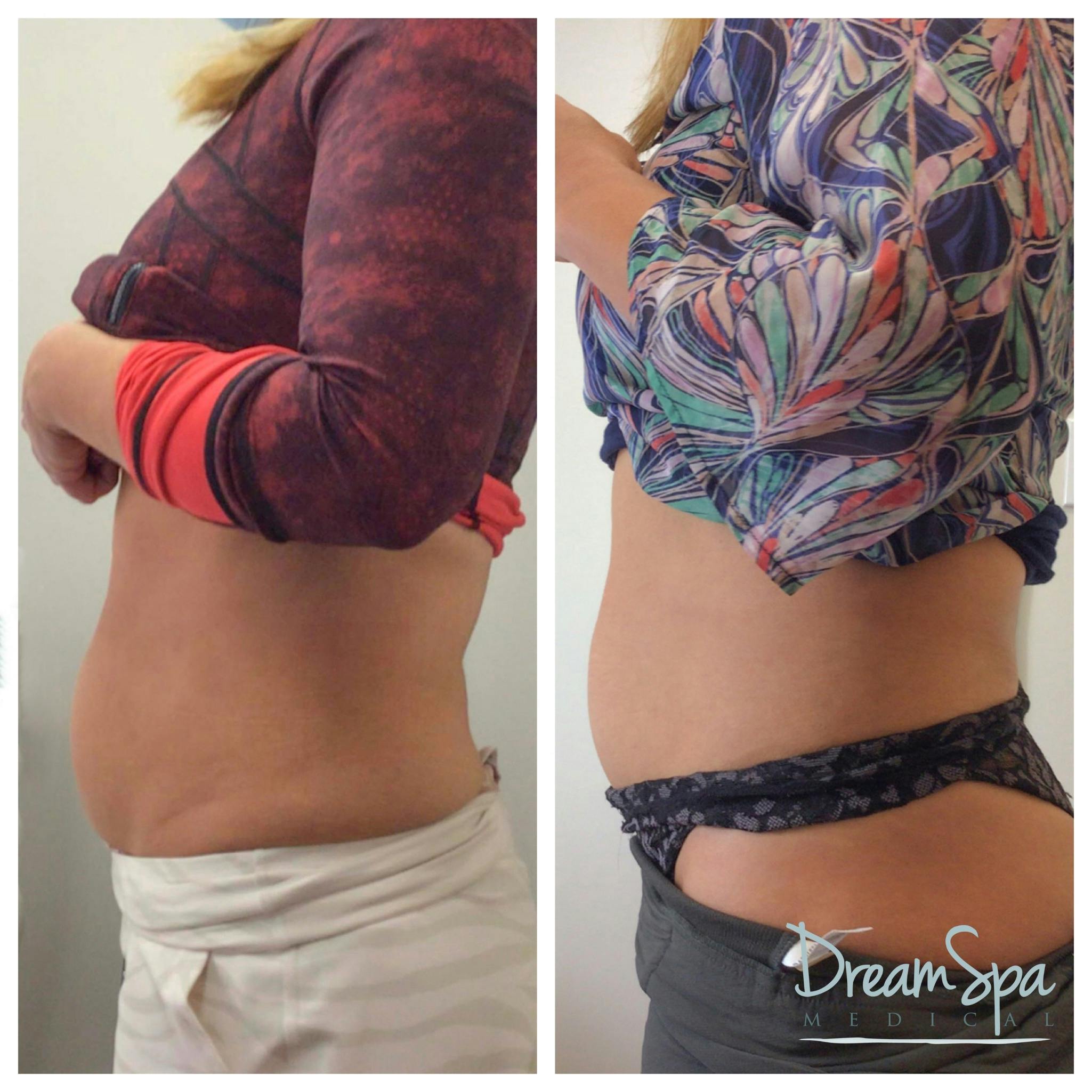 Body Contouring Before & After Gallery - Patient 109504938 - Image 1