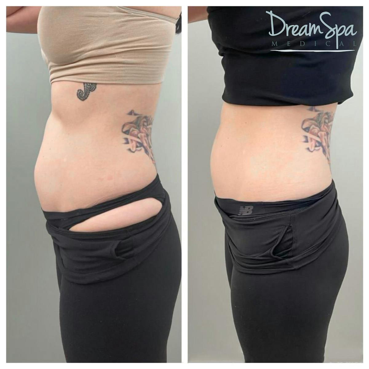 Body Contouring Before & After Gallery - Patient 109504939 - Image 1