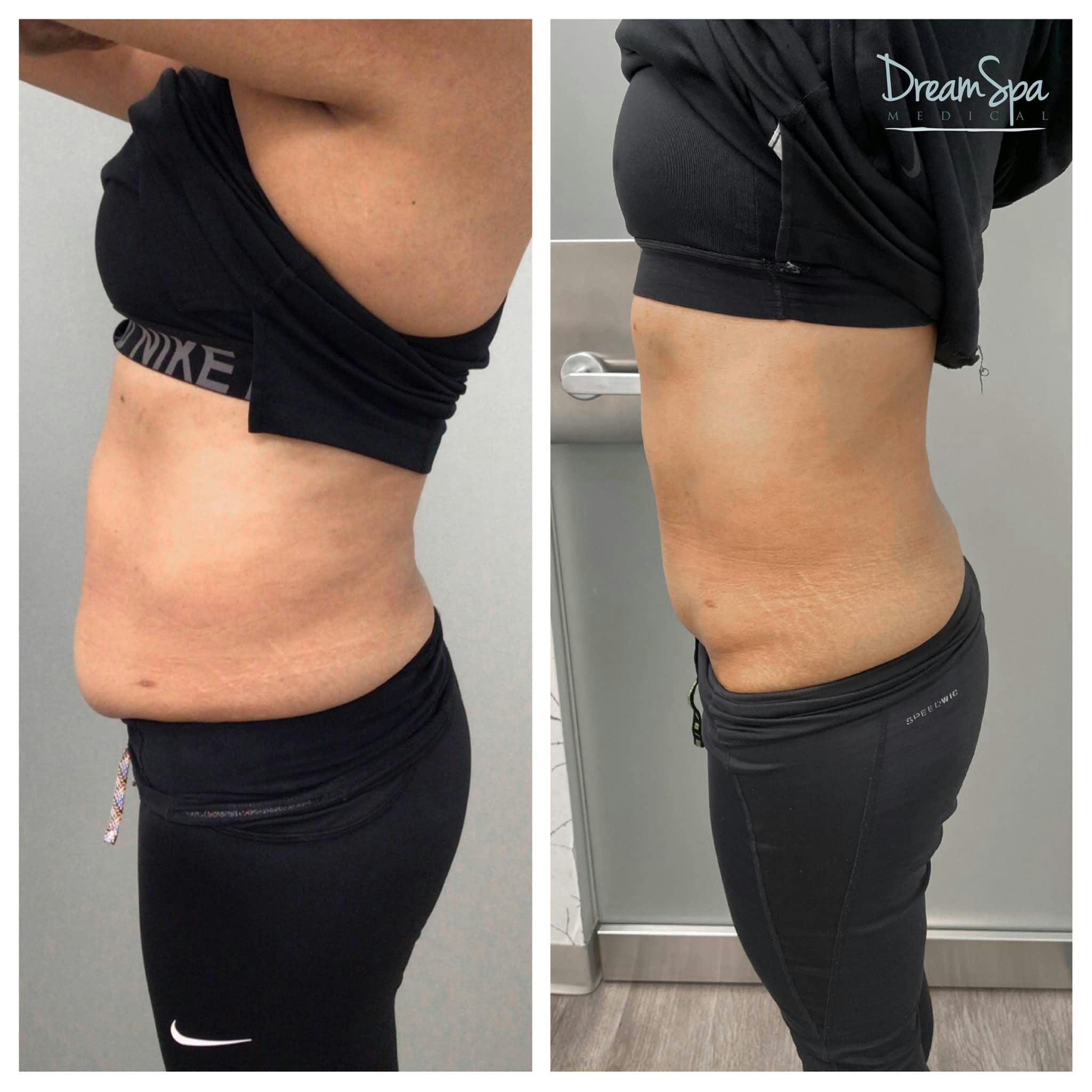 Body Contouring Before & After Gallery - Patient 118348747 - Image 1