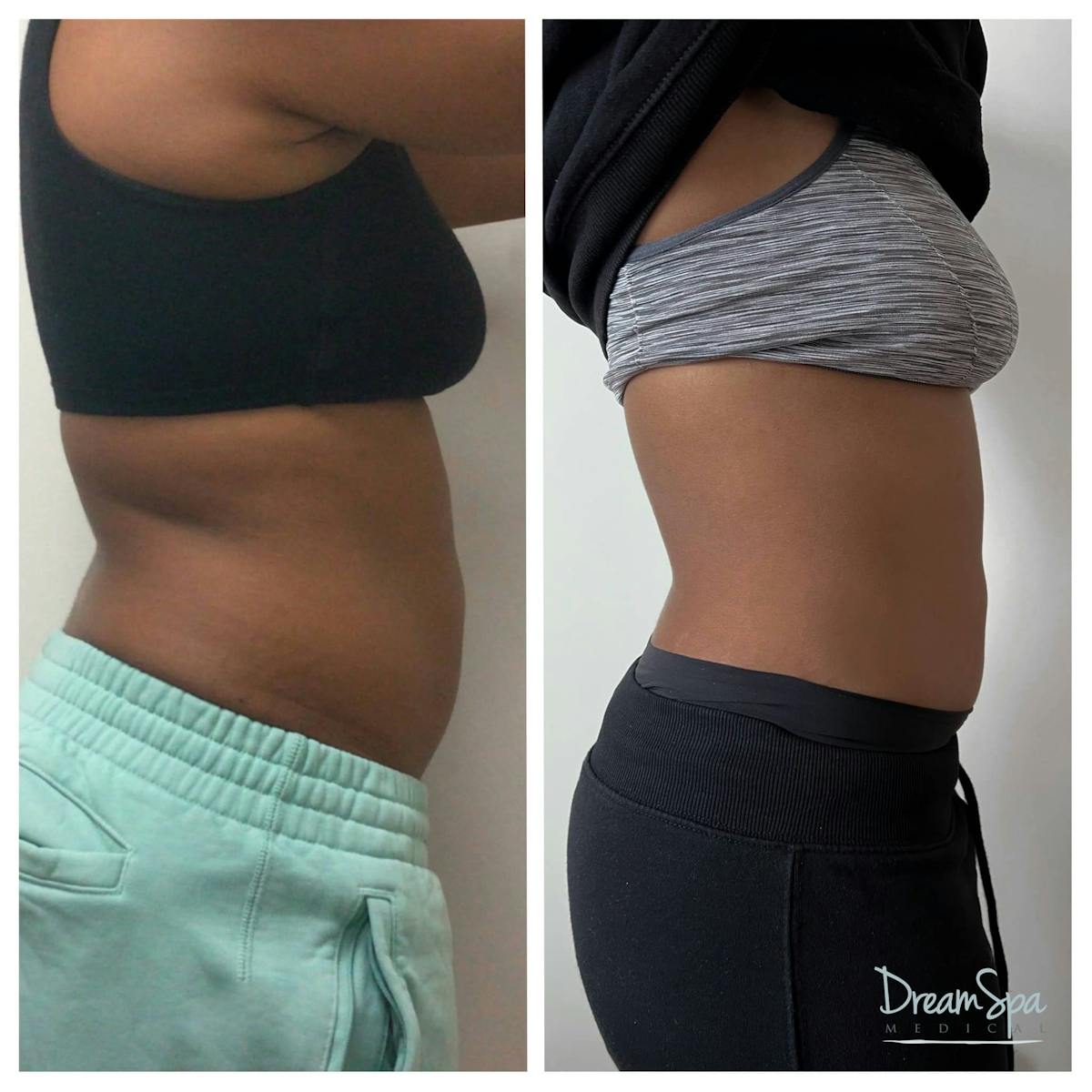 Body Contouring Before & After Gallery - Patient 118348748 - Image 1