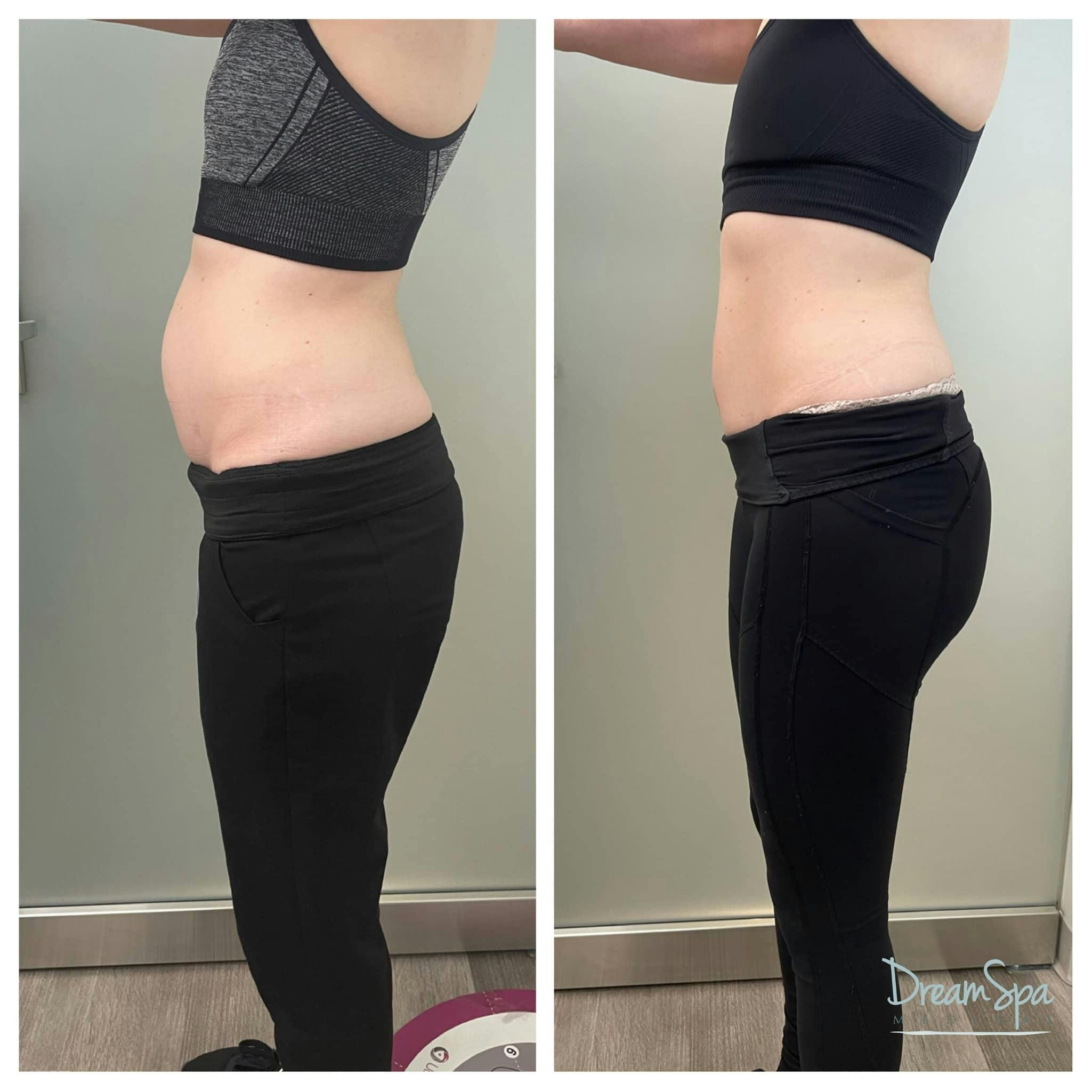 Body Contouring Before & After Gallery - Patient 118348749 - Image 1
