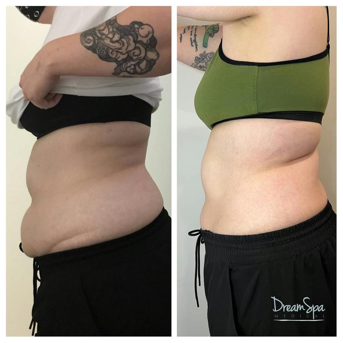 Body Contouring Before & After Gallery - Patient 118348750 - Image 1