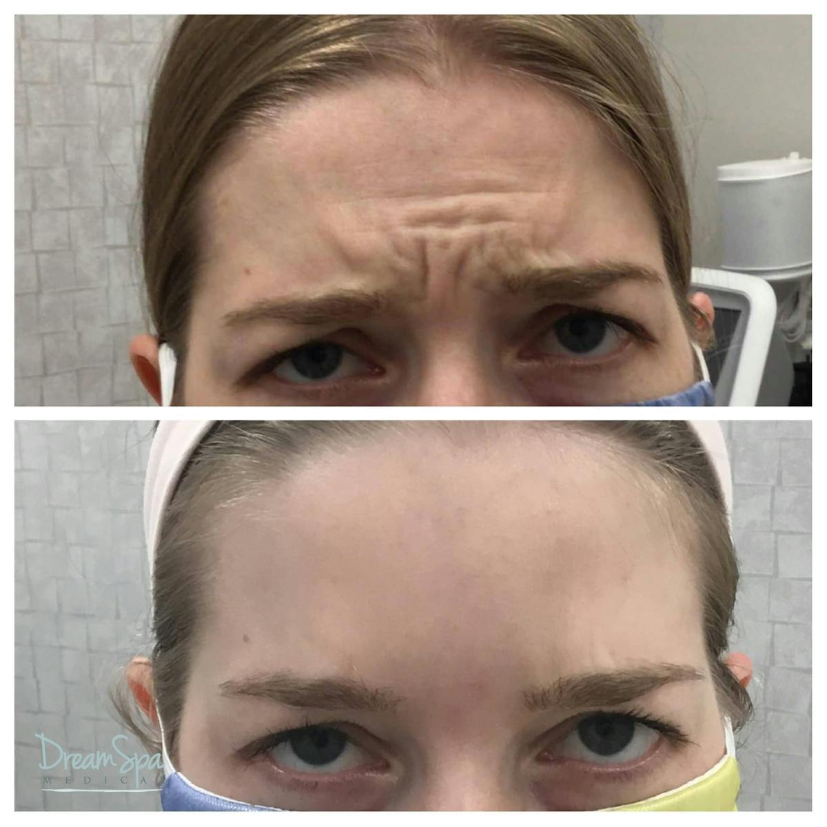 Botox Before & After Gallery - Patient 118348895 - Image 1