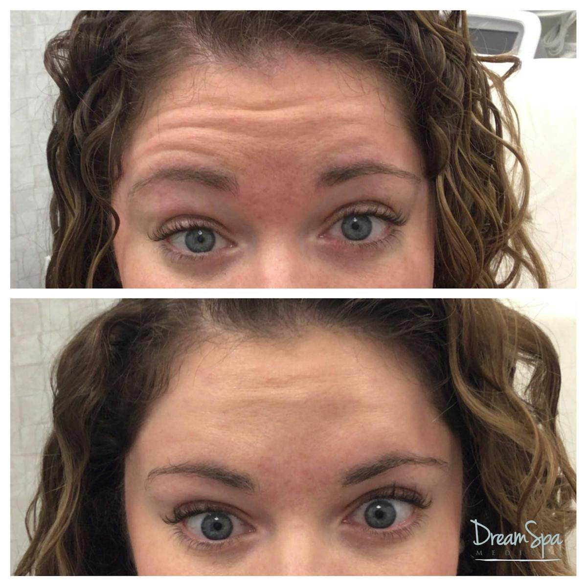 Botox Before & After Gallery - Patient 118348896 - Image 1