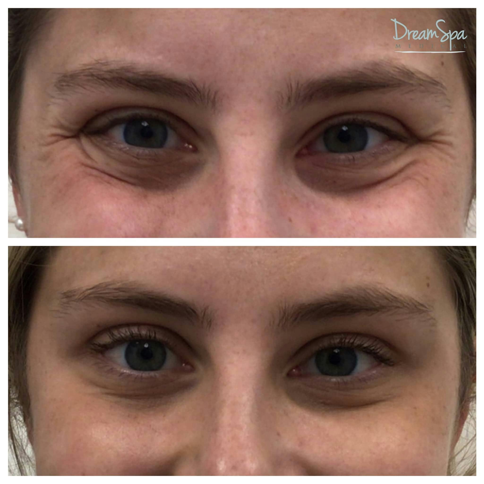 Botox Before & After Gallery - Patient 118348897 - Image 1