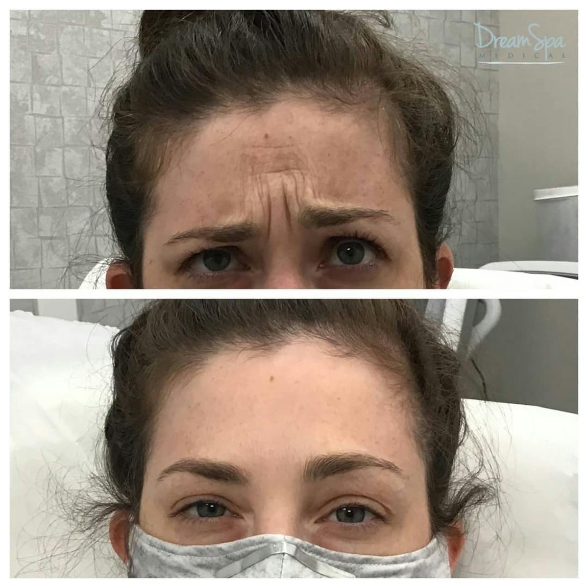 Botox Before & After Gallery - Patient 118348898 - Image 1