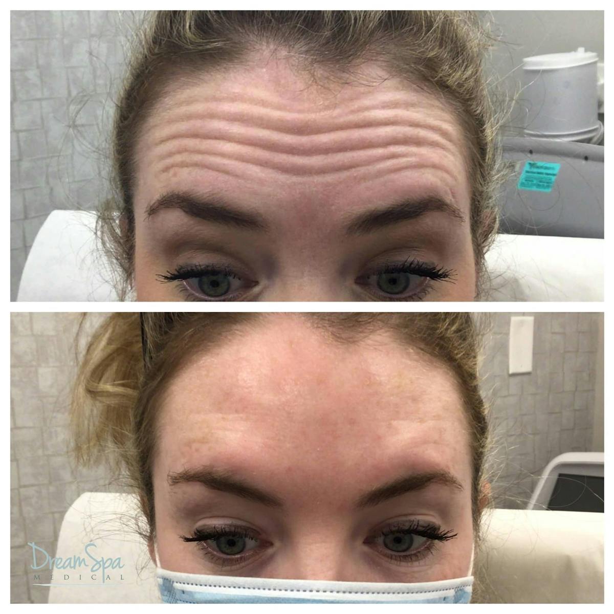 Botox Before & After Gallery - Patient 118348899 - Image 1