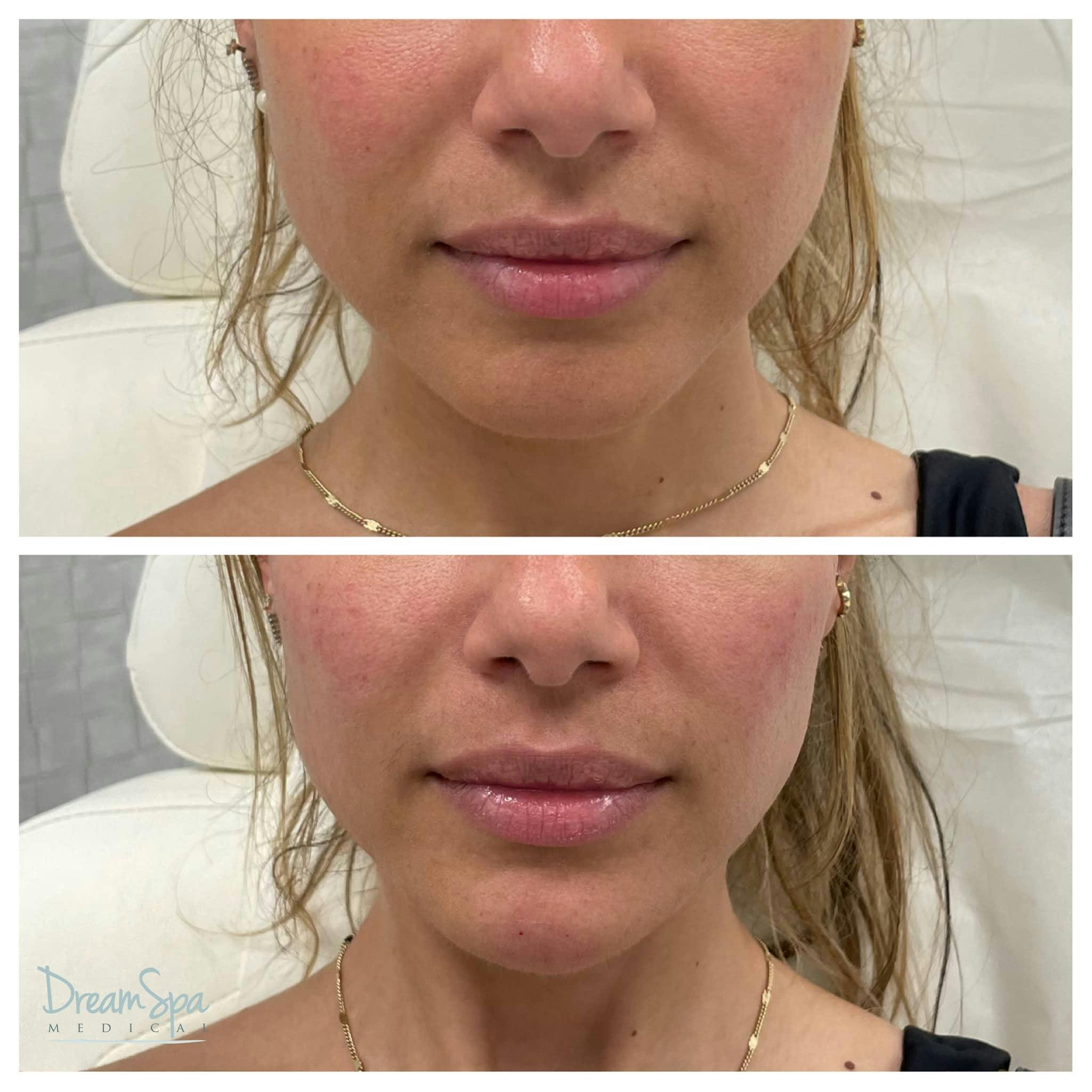 Patient 118350641 Chin Filler Before & After Photos Dream Spa Medical