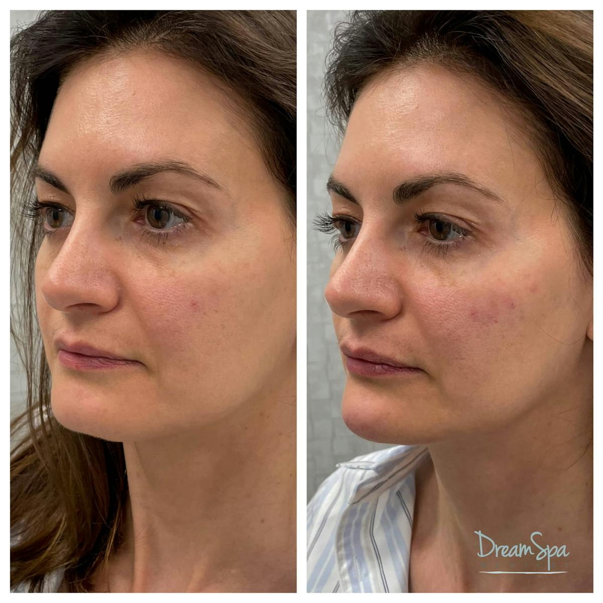 Dream Contour™ Before & After Gallery - Patient 118351011 - Image 1