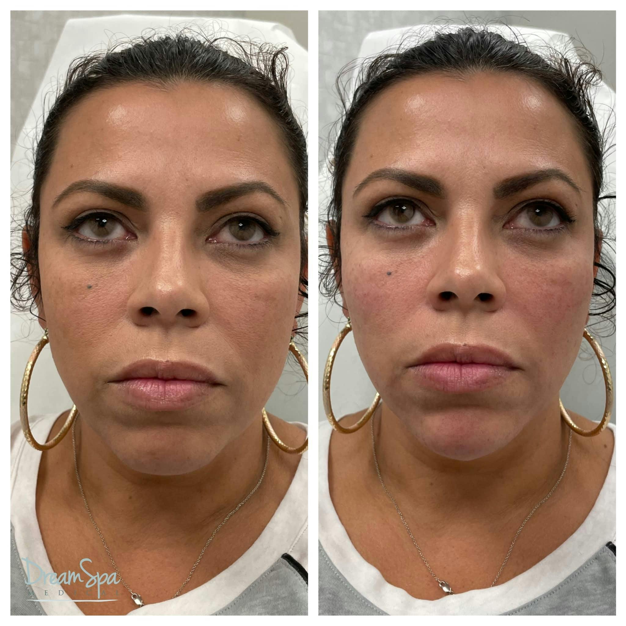 Dream Contour™ Before & After Gallery - Patient 118351012 - Image 1