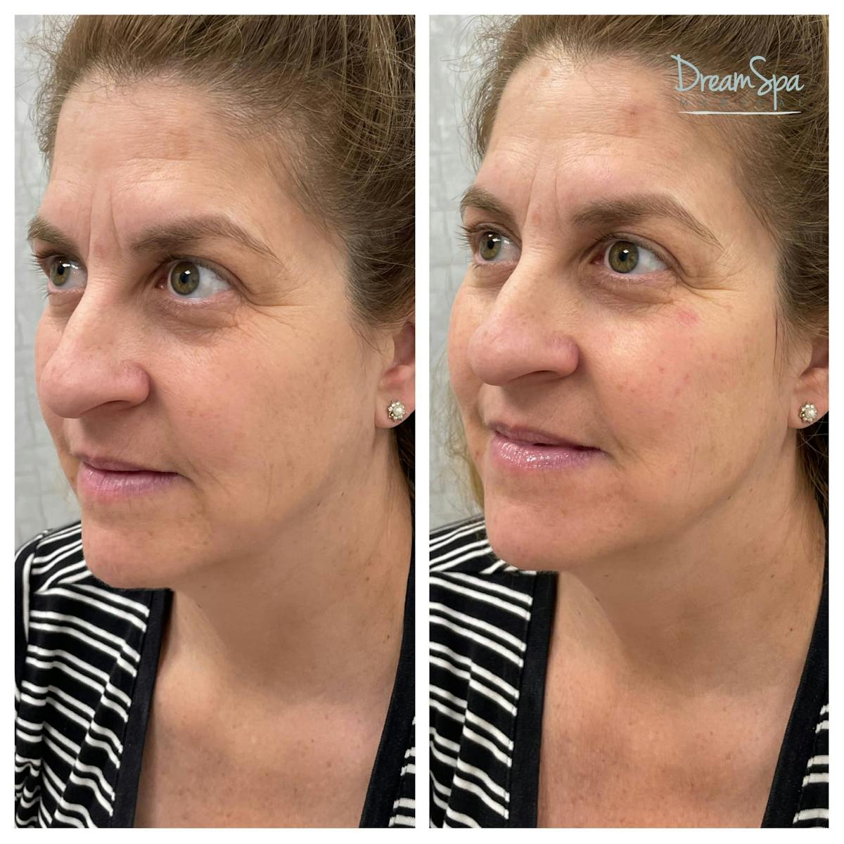 Dream Contour™ Before & After Gallery - Patient 118351013 - Image 1