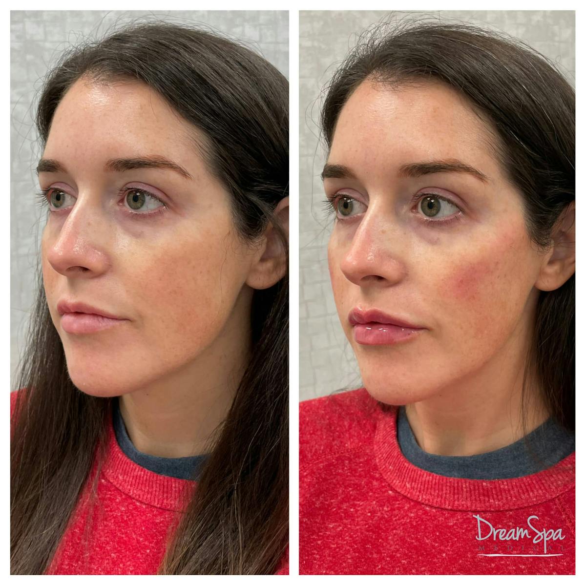 Dream Contour™ Before & After Gallery - Patient 118351014 - Image 1
