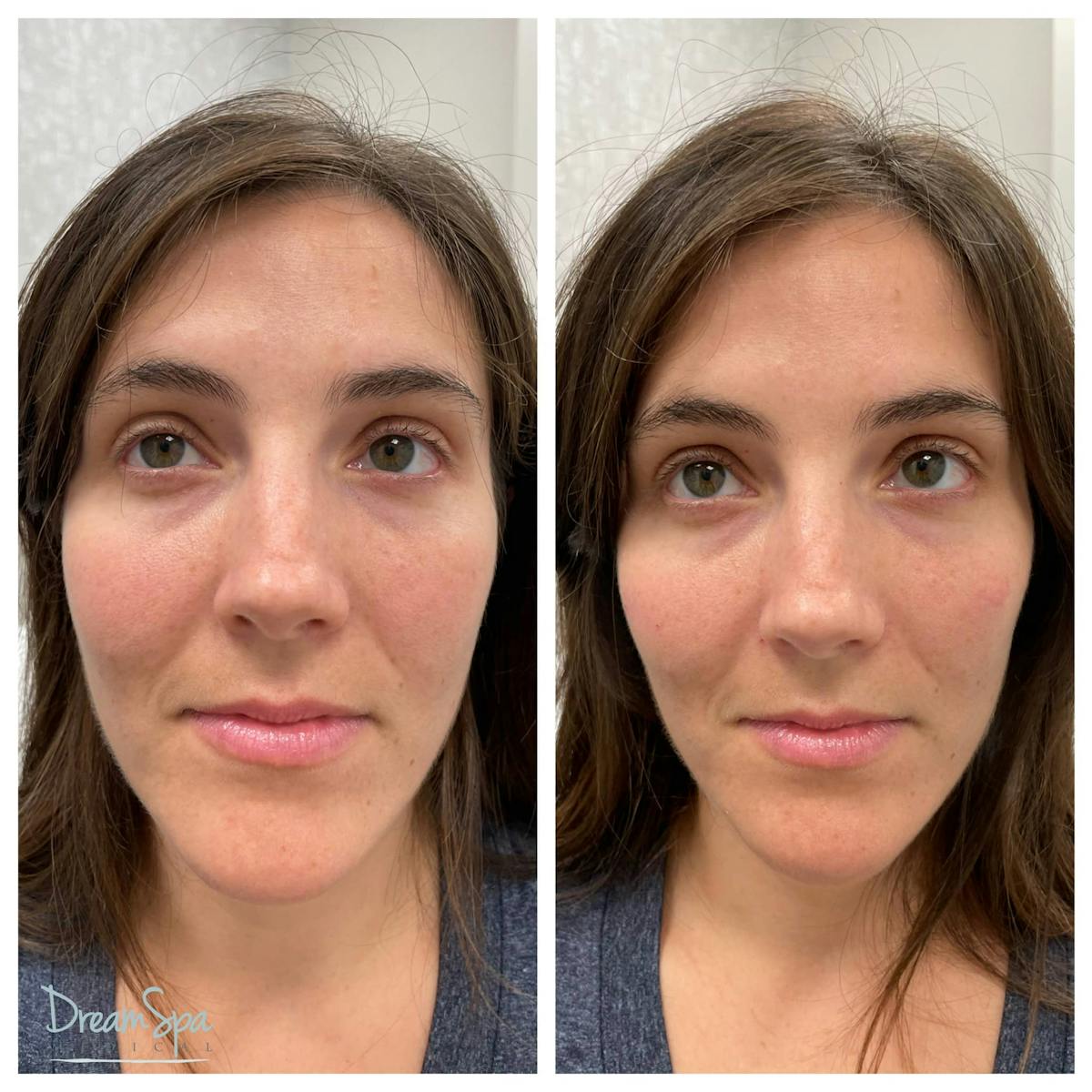 Dream Contour™ Before & After Gallery - Patient 118351015 - Image 1