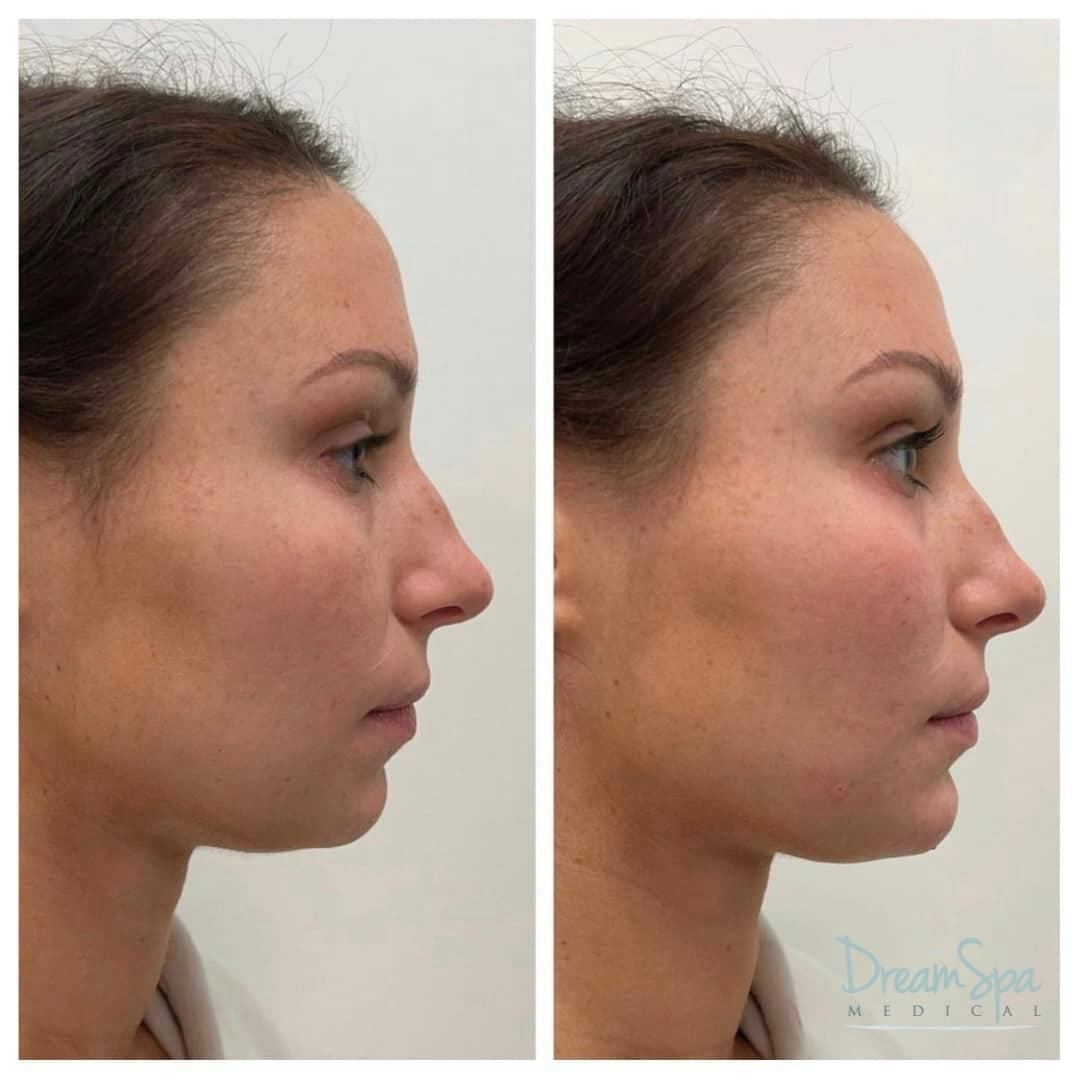 Dream Contour™ Before & After Gallery - Patient 118351016 - Image 1