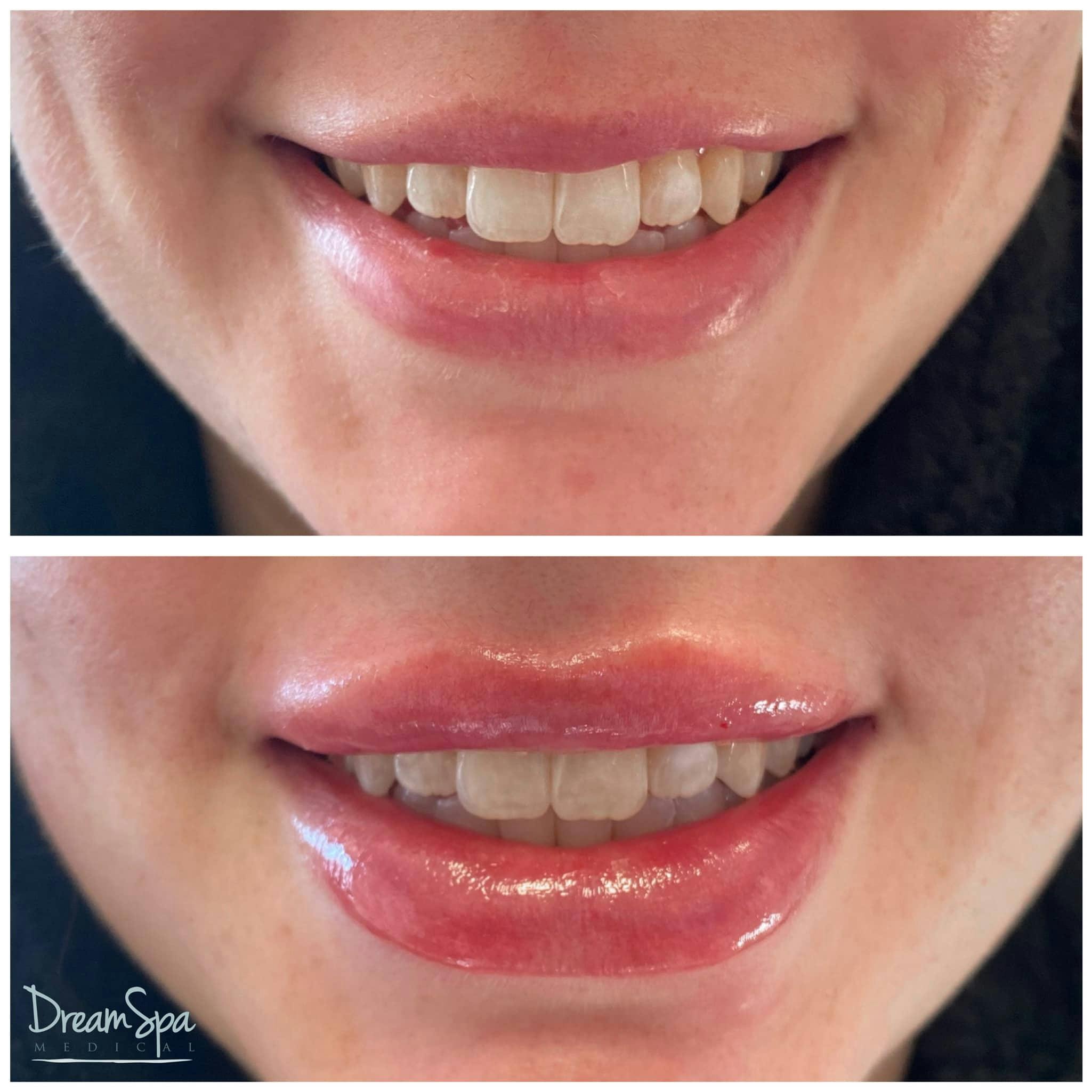 Lip Filler Before & After Gallery - Patient 118351193 - Image 1