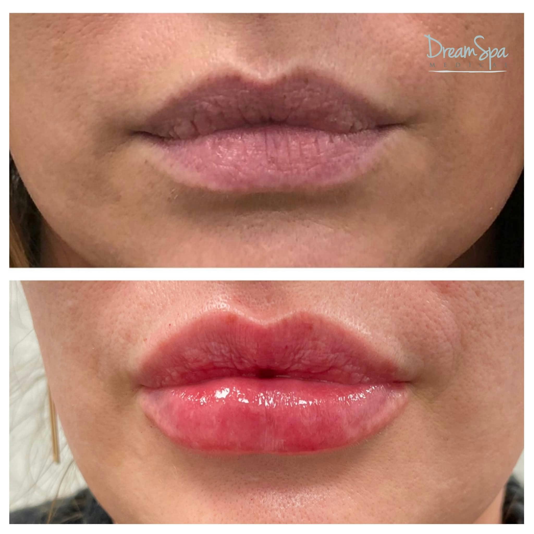 Lip Filler Before & After Gallery - Patient 118351194 - Image 1