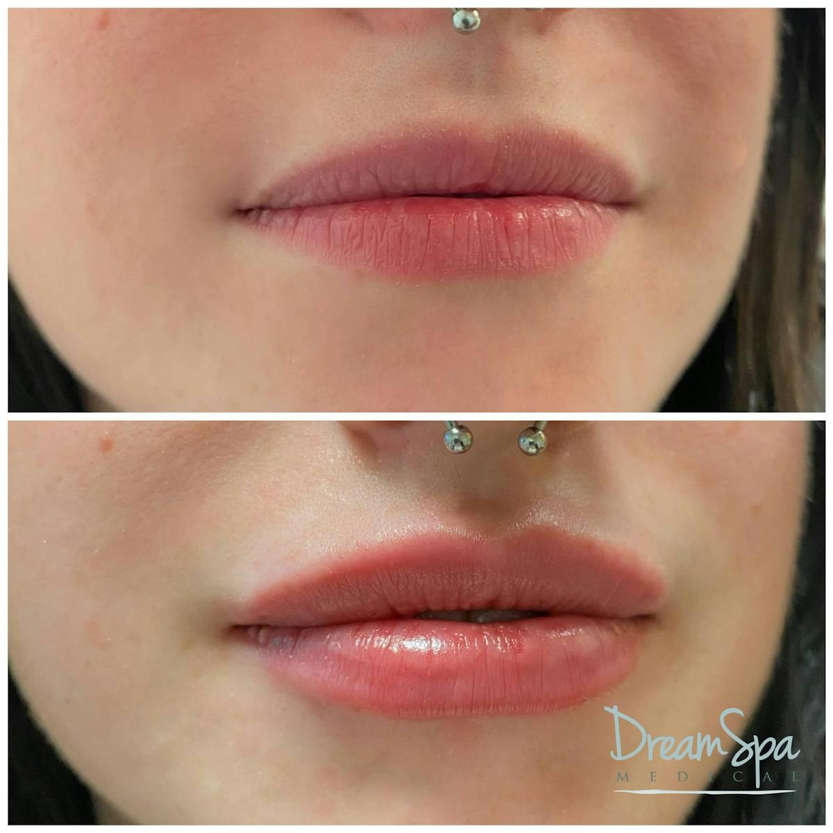 Lip Filler Before & After Gallery - Patient 118351195 - Image 1