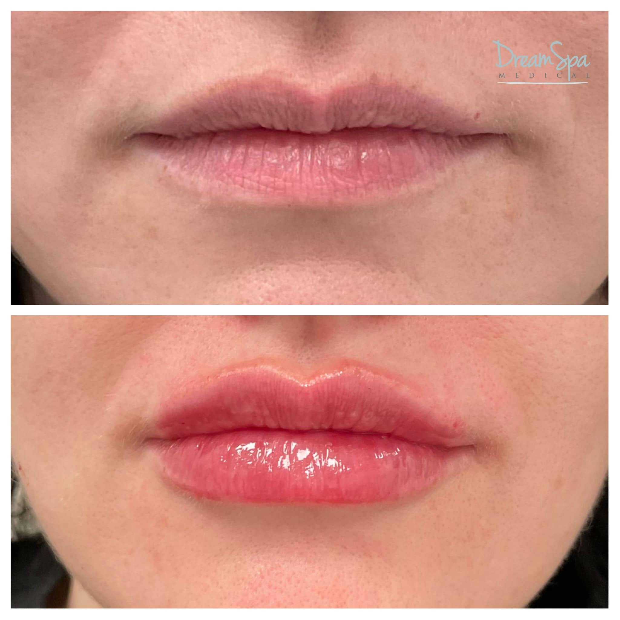 Lip Filler Before & After Gallery - Patient 118351197 - Image 1