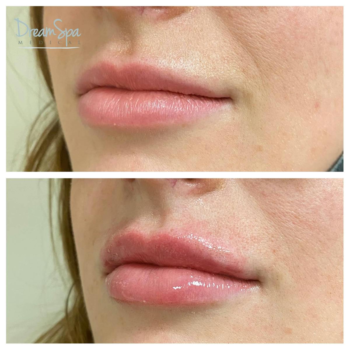 Lip Filler Before & After Gallery - Patient 118351198 - Image 1